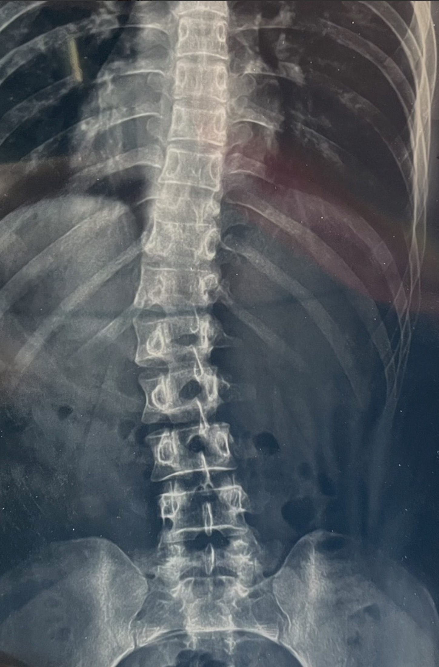 เด็กหลังคดแต่กำเนิด (Congenital Scoliosis) — รู้ไว รักษาทัน ลูกไม่ต้องทรมานตอนโต
