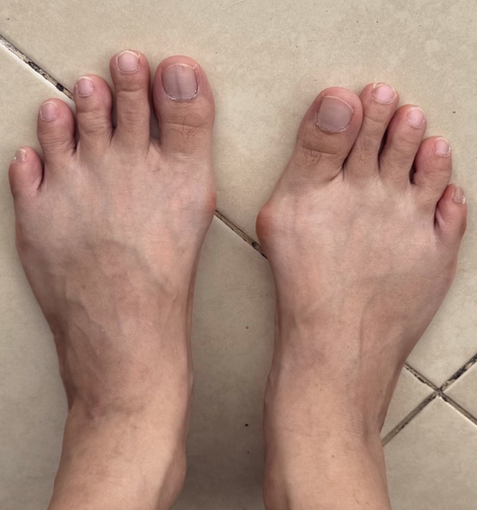 หัวแม่เท้าเก (Hallux Valgus) รักษาได้ด้วยการผ่าตัดแผลเล็ก เดินได้ไว ฟื้นตัวเร็ว!