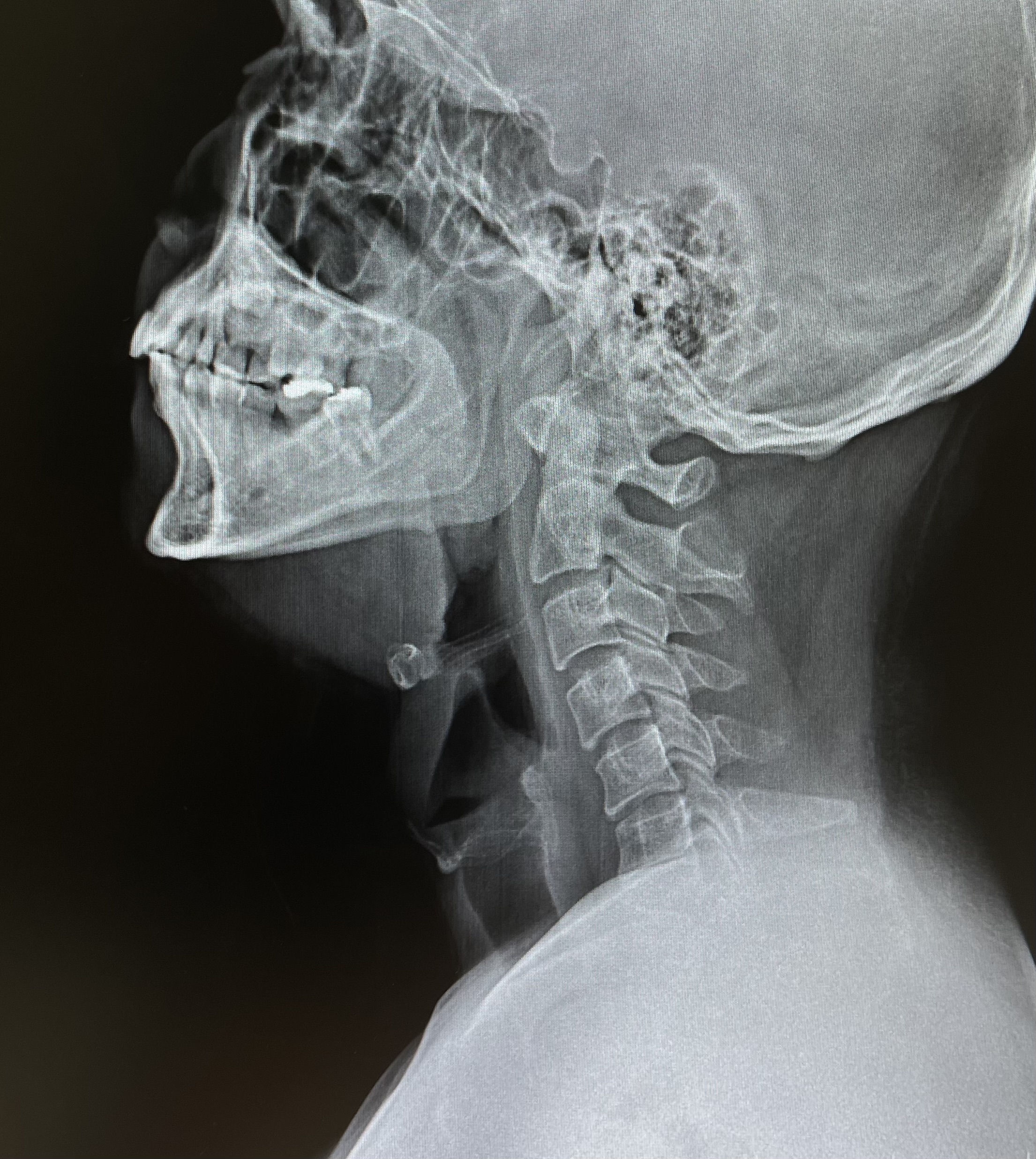 ปวดคอ นอนตกหมอน คอเคล็ด…ระวังสัญญาณกระดูกคอผิดรูป (Kyphotic deformity) และอาการชาที่นิ้วโป้ง