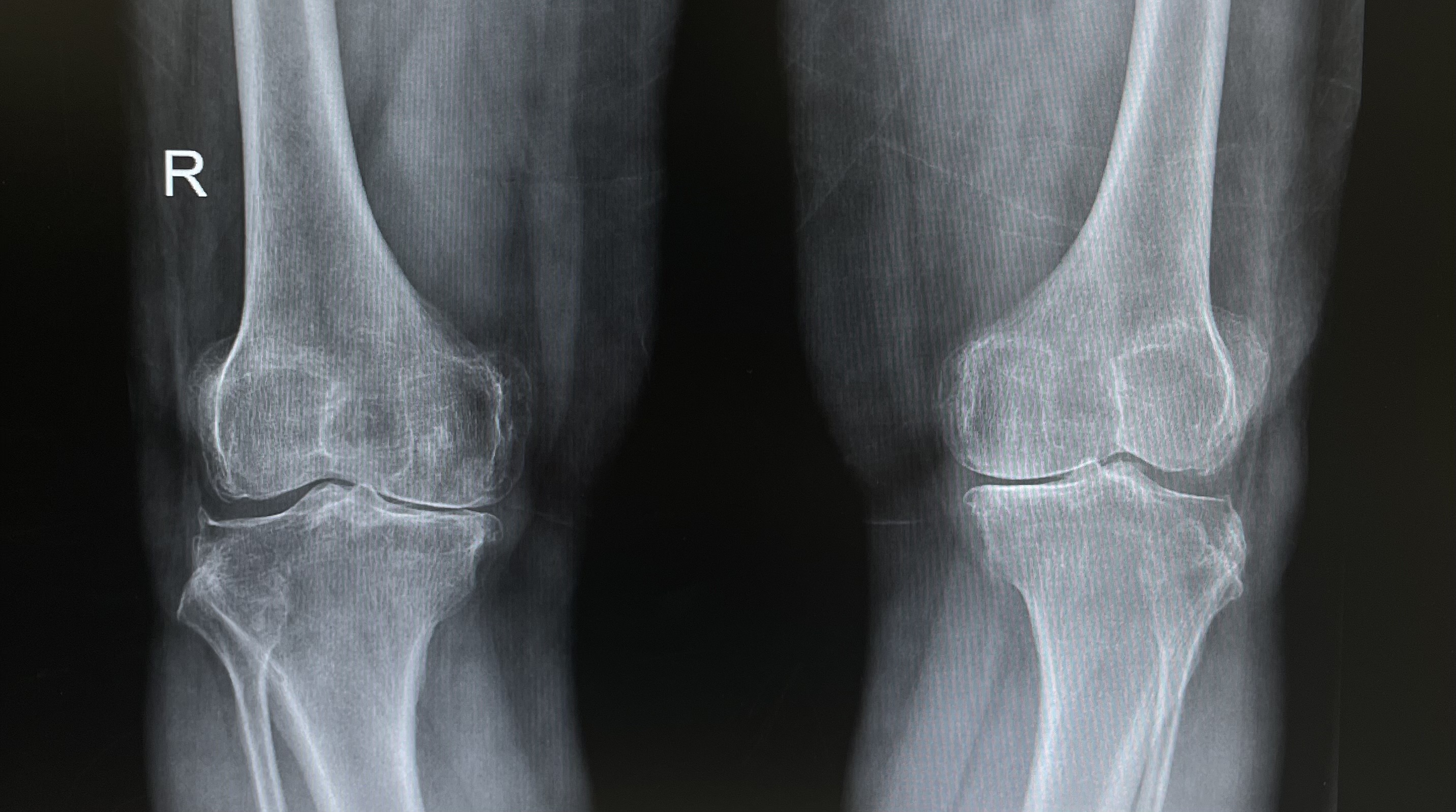 เข่าเสื่อม (Knee Osteoarthritis) — ปวดเข่า เดินขึ้นบันไดลำบาก เรื่องใกล้ตัวที่รักษาได้