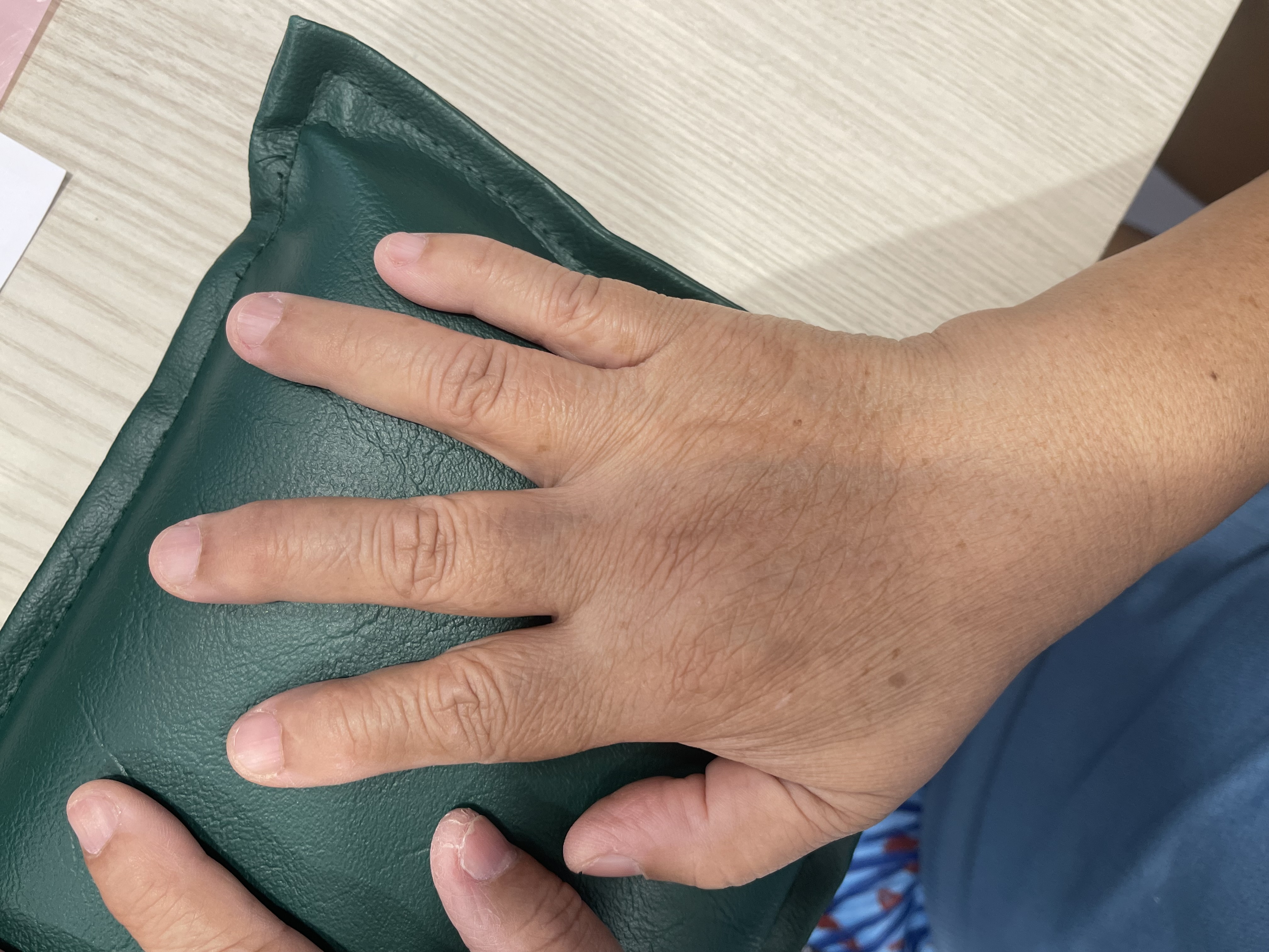 ข้อนิ้วเสื่อม (Finger Joint Osteoarthritis) — นิ้วบวม ปวด ขยับแล้วดังกร๊อบ ๆ รักษาได้ไหม?