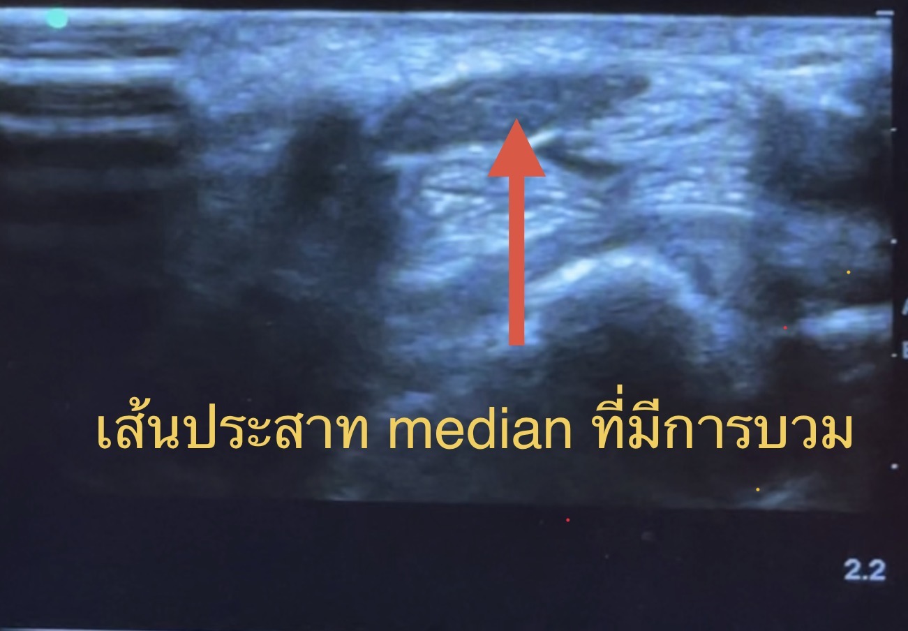 มือชา นิ้วชา เพราะเส้นประสาทถูกพังผืดรัด — รักษาได้ด้วยเทคนิคฉีดยาแบบแม่นยำด้วย Ultrasound (Hydrodissection)