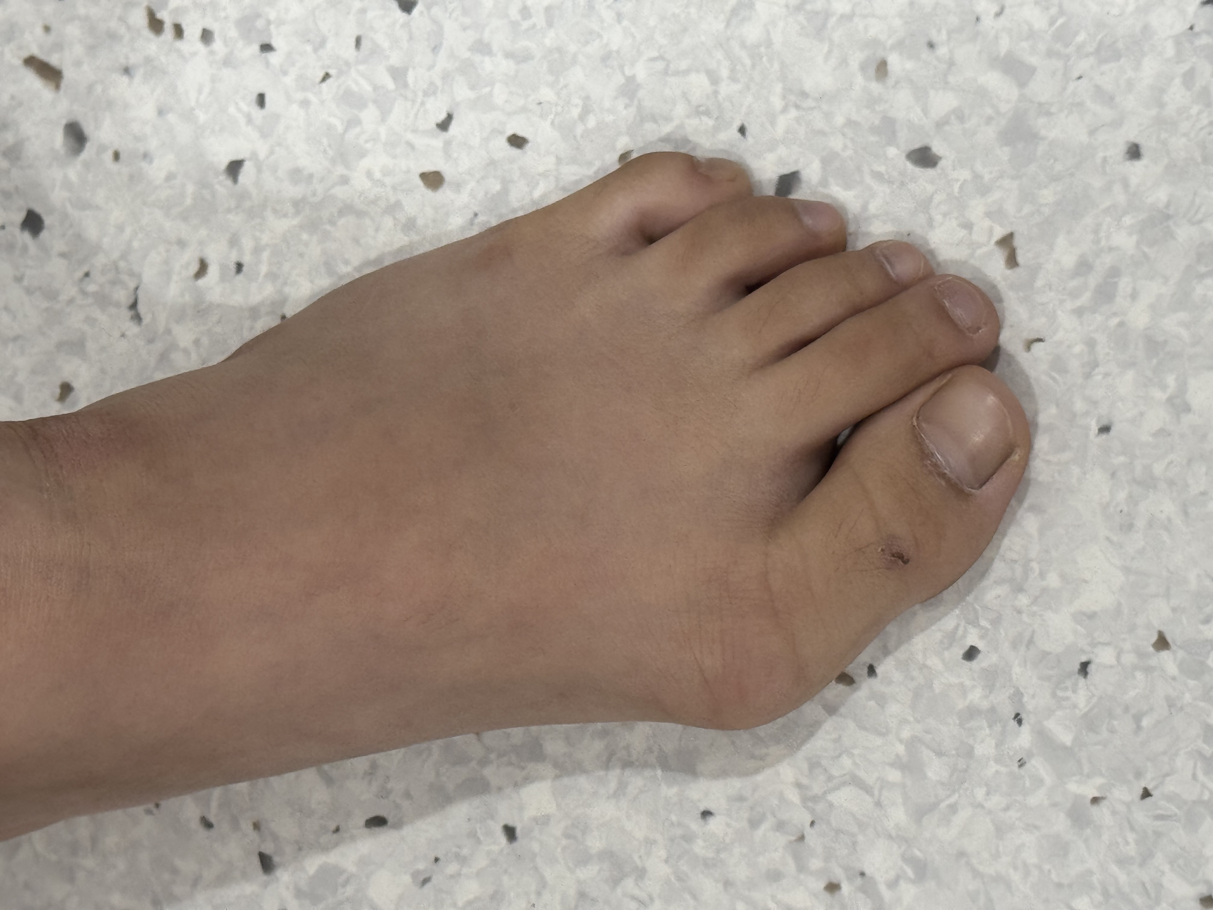 หัวแม่เท้าเกในเด็ก (Juvenile Hallux Valgus) — นิ้วเท้าเบี้ยวตั้งแต่ยังเล็ก แก้ได้ไหม?