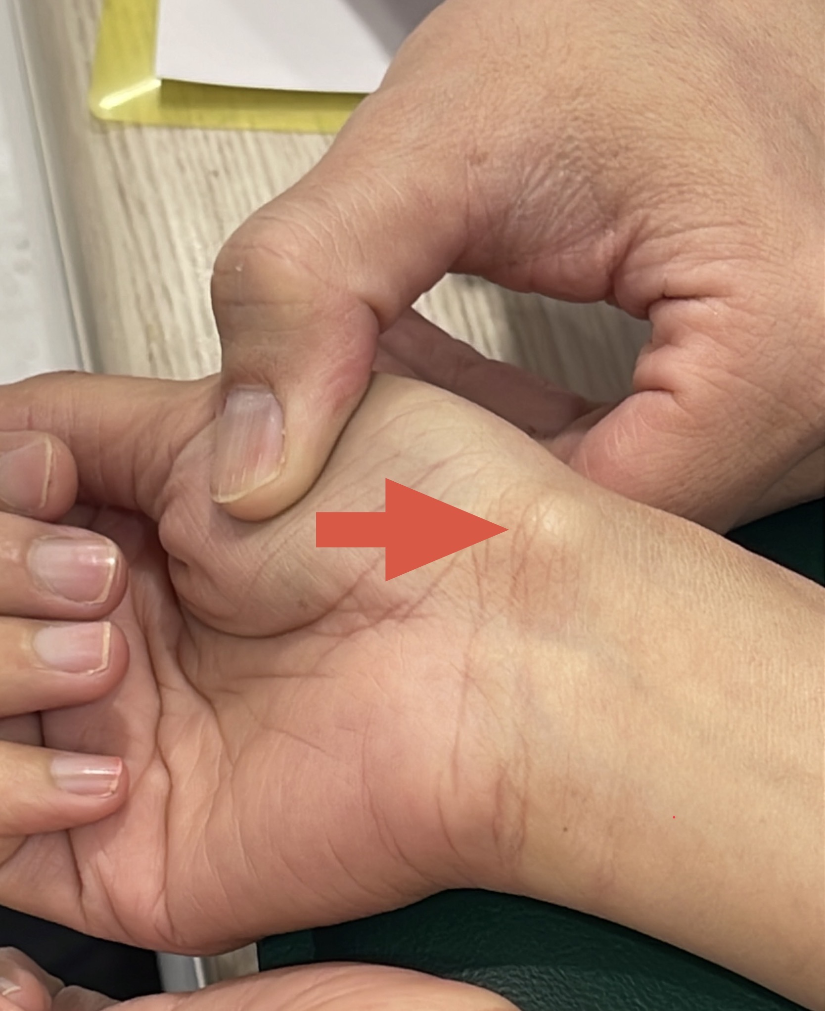 ถุงน้ำที่ข้อมือ (Carpal Ganglion Cyst) — ก้อนนิ่ม ๆ ใต้ผิวหนัง ไม่อันตราย แต่ไม่ควรปล่อยไว้