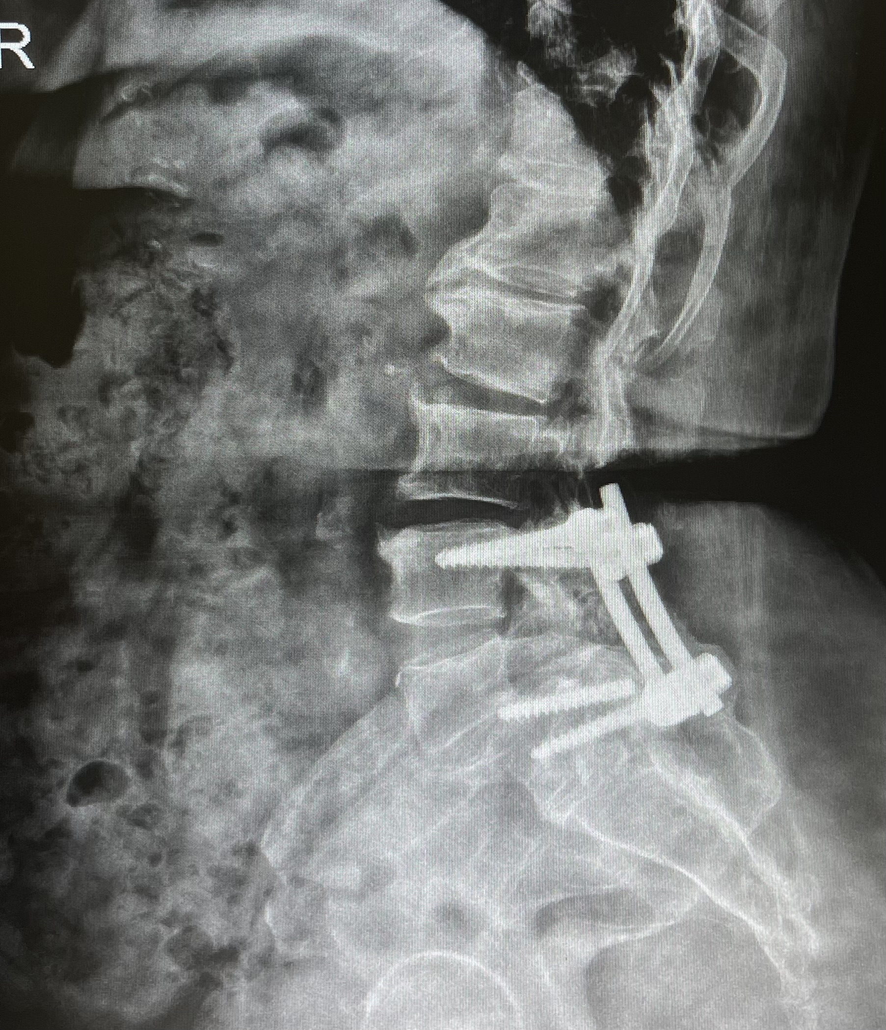 สกรูดามหลังหักหลังผ่าตัด (Pedicle Screw Breakage) — อาการ สาเหตุ และแนวทางแก้ไข