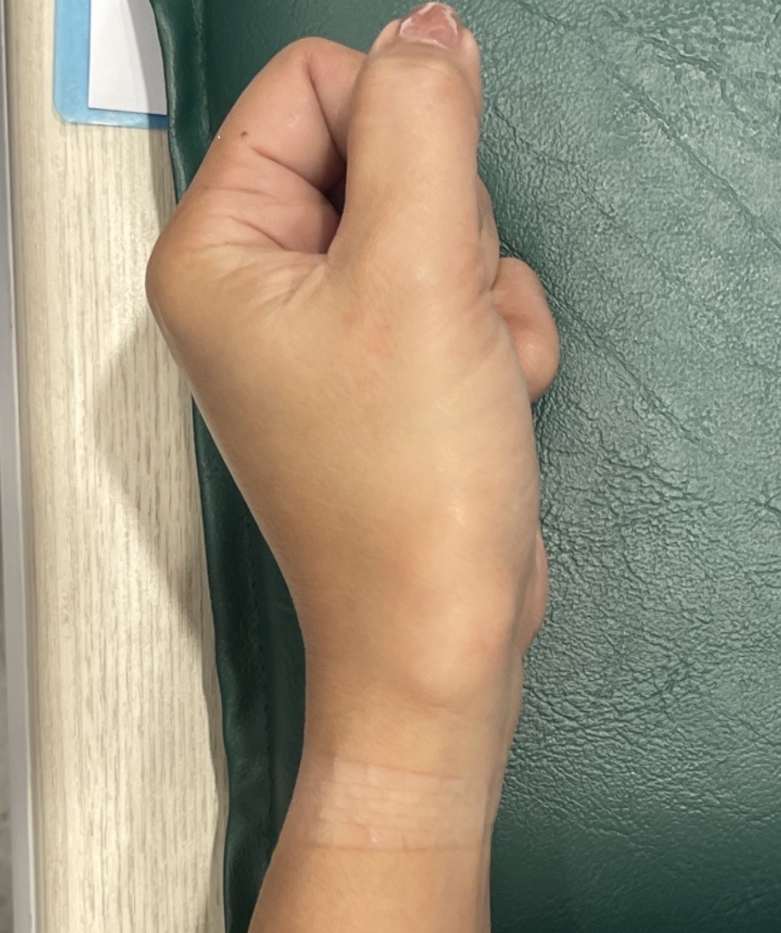 ก้อนที่หลังมือหรือนิ้วมือ…อาจไม่ใช่ถุงน้ำ!