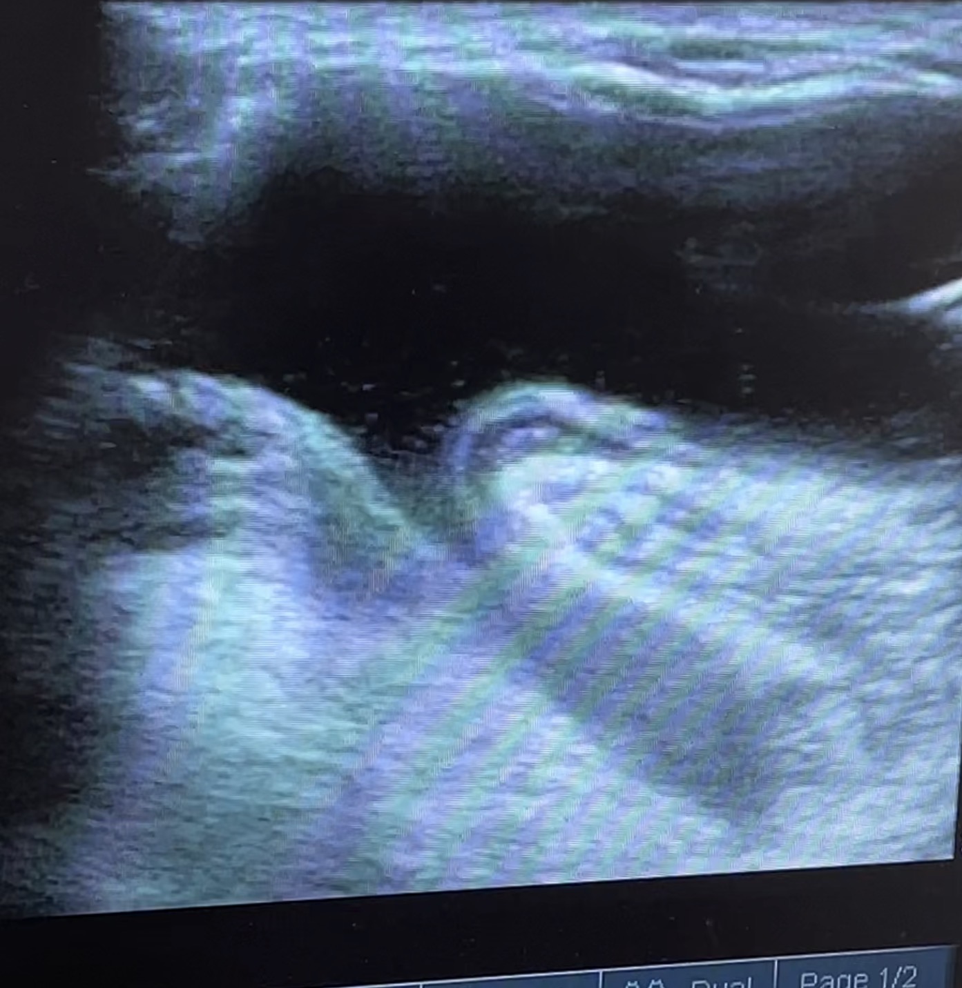 ถุงน้ำหลังเข่า (Baker’s Cyst) คืออะไร?