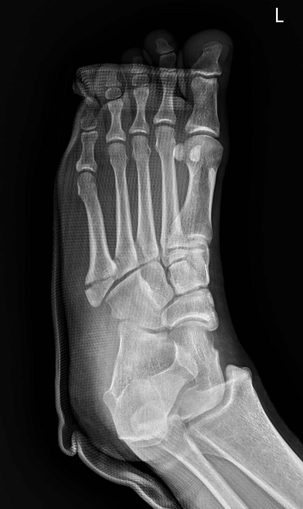 กระดูกเท้าแตกบริเวณฐานของกระดูกฝ่าเท้าที่ 5 (Fracture base of 5th metatarsal) คืออะไร? และทำไมบางกรณีต้องผ่าตัด?