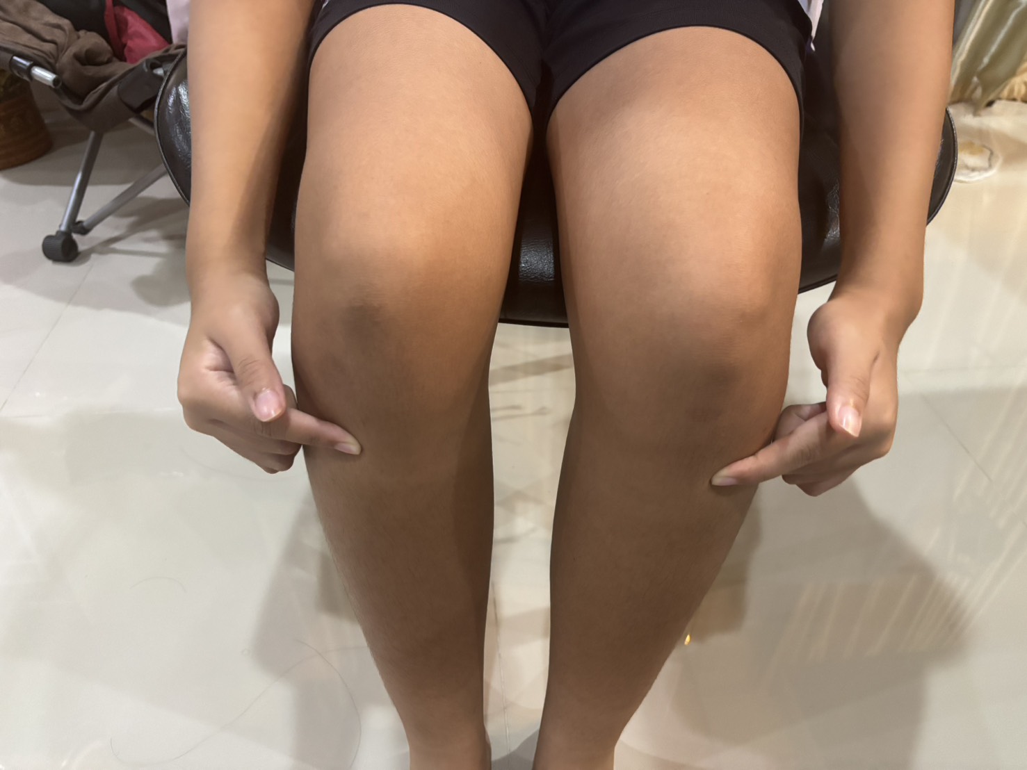ปวดใต้เข่าในนักกีฬาเยาวชน เกิดจากอะไร? (Osgood–Schlatter disease)