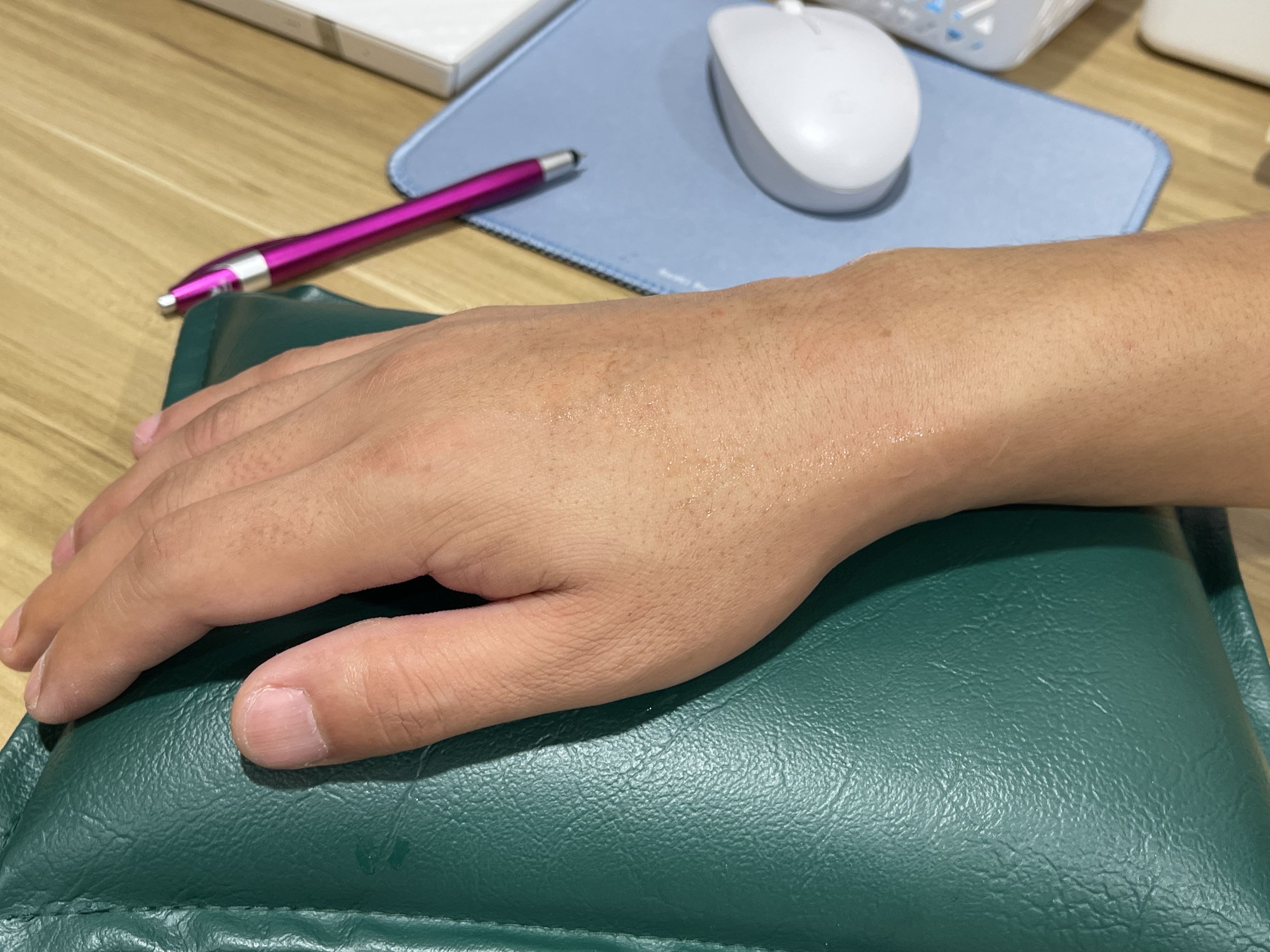 ปวดข้อมือ ขยับแล้วเจ็บ — ระวัง “ข้อข้อมืออักเสบ (Wrist Arthritis)” ไม่ใช่แค่เมื่อยจากการใช้มือถือ!