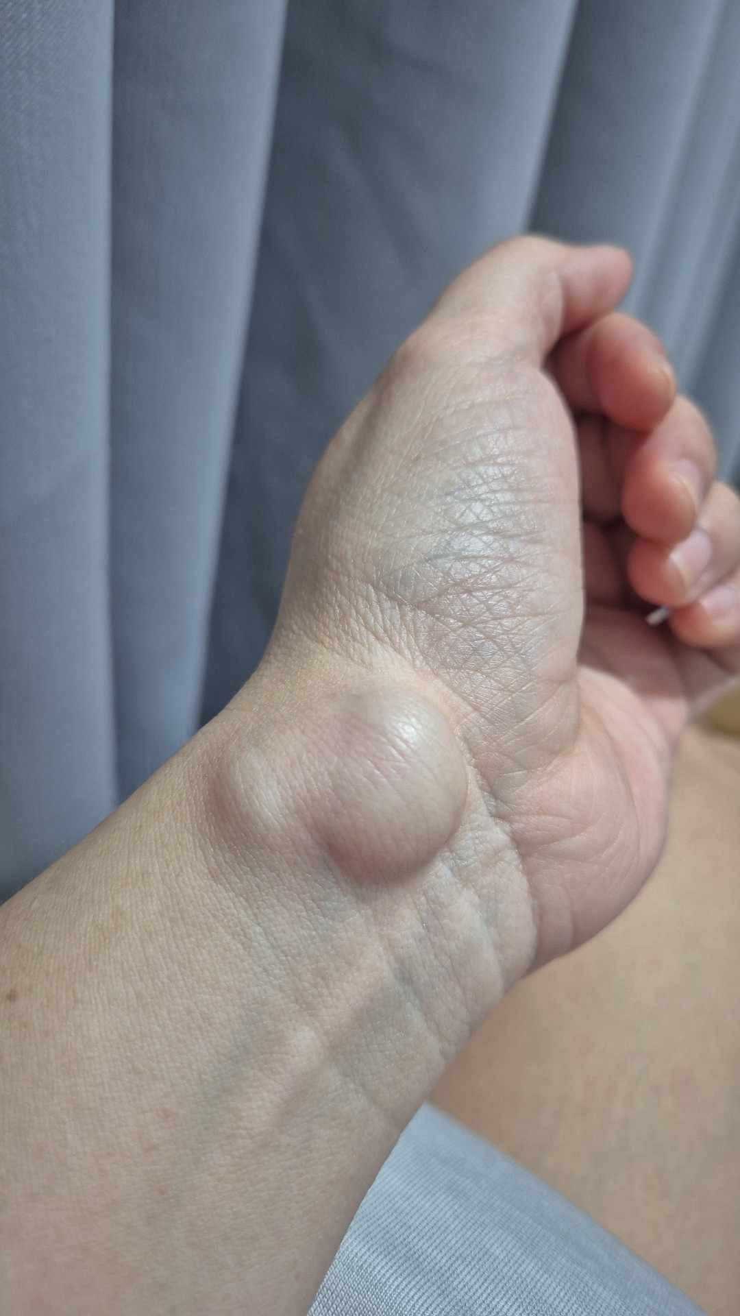 มีก้อนที่ข้อมือด้านฝ่ามือฝั่งนิ้วโป้ง — หมออยากบอกว่าอย่าเพิ่งรีบกดหรือเจาะ!