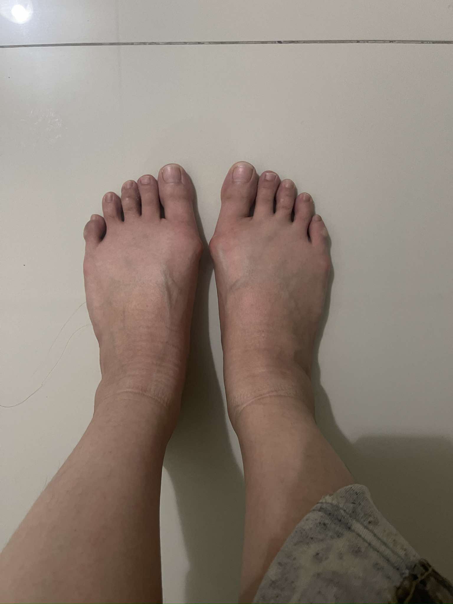 หัวแม่เท้าเก (Hallux Valgus) – ยิ่งปล่อยไว้นาน ยิ่งปวด เดินลำบาก