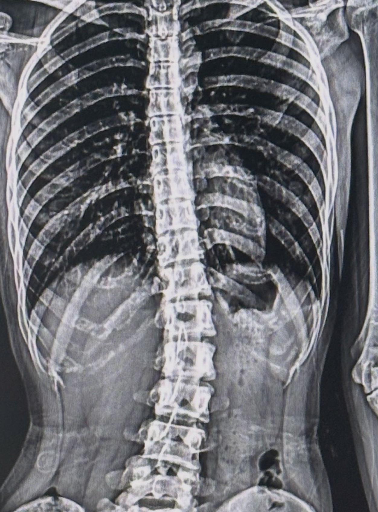 กระดูกสันหลังคดแต่กำเนิด (Congenital Scoliosis) – บางคนเพิ่งรู้ว่าตัวเองเป็นตอนโต!
