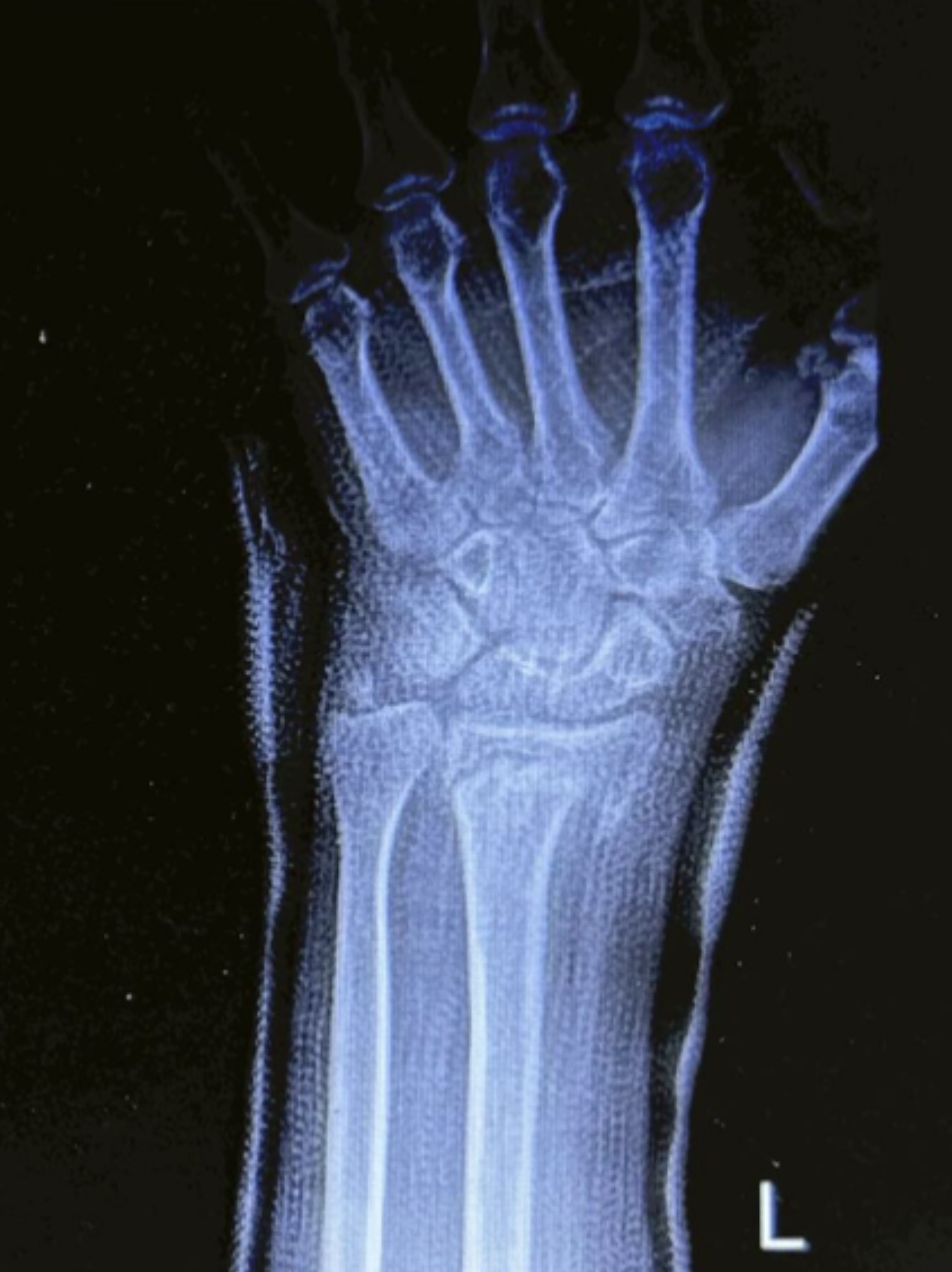 กระดูกข้อมือหักในผู้สูงอายุ 65 ปีขึ้นไป ต้องผ่าตัดหรือไม่? และถ้าไม่ผ่าอนาคตจะเป็นอย่างไร