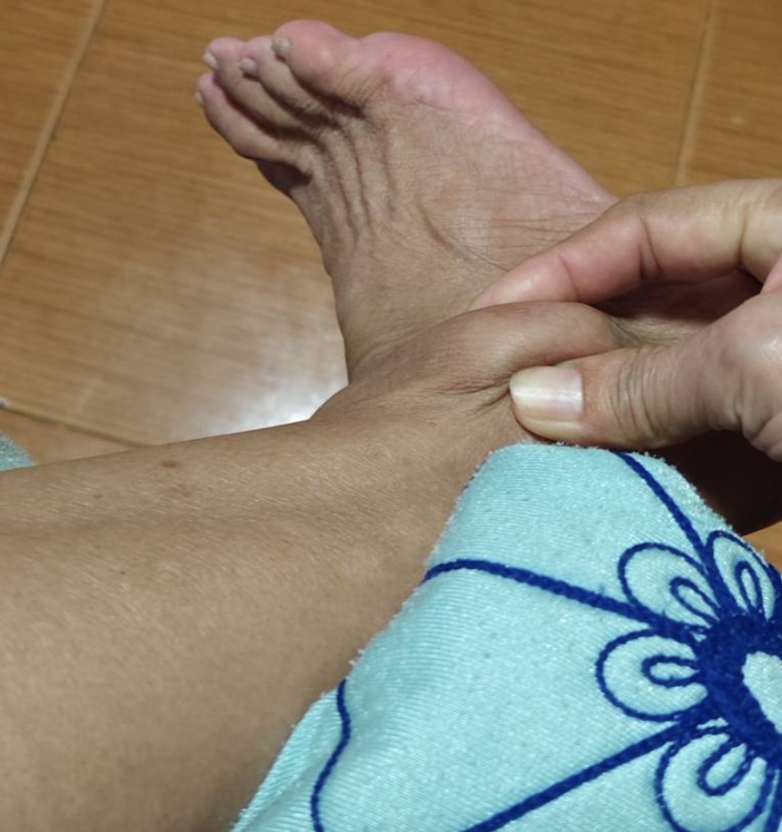 ตาตุ่มบวมกดนุ่ม อาจเป็น “Malleolus Bursitis” หรือถุงน้ำอักเสบที่ข้อเท้า