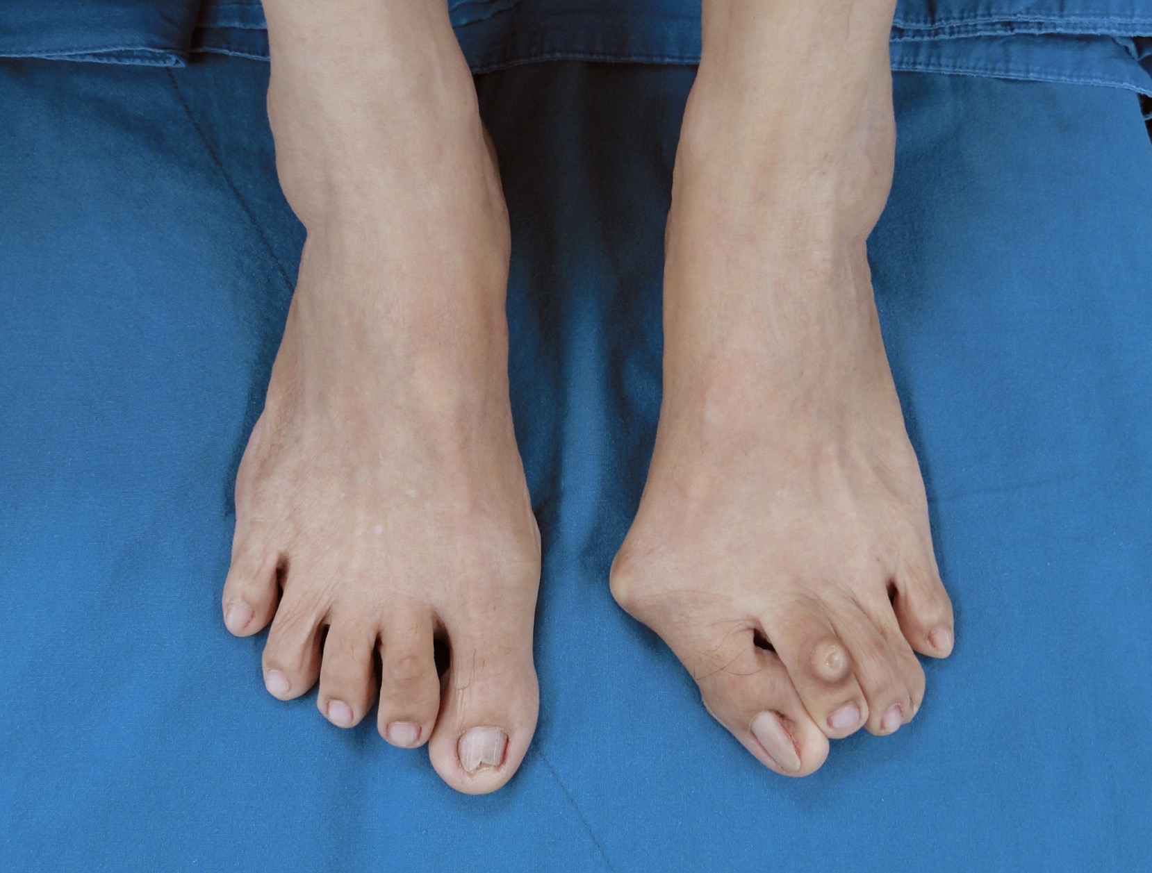 Hallux Valgus (นิ้วหัวแม่เท้าเก) รักษาอย่างไรได้บ้าง? สรุปแนวทางแบบเข้าใจง่ายและใช้ได้จริง