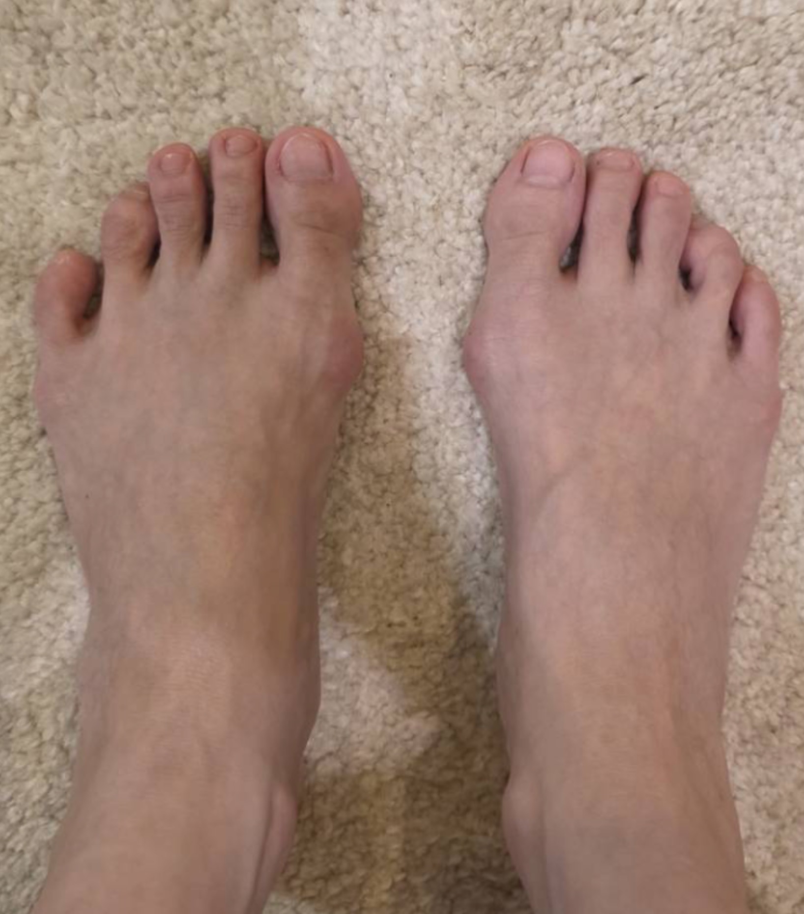 นิ้วหัวแม่เท้าเก (Hallux Valgus) จำเป็นต้องผ่าตัดไหม? และปัจจุบันรักษาด้วยการผ่าตัดแผลเล็กแบบ Percutaneous ได้อย่างไร
