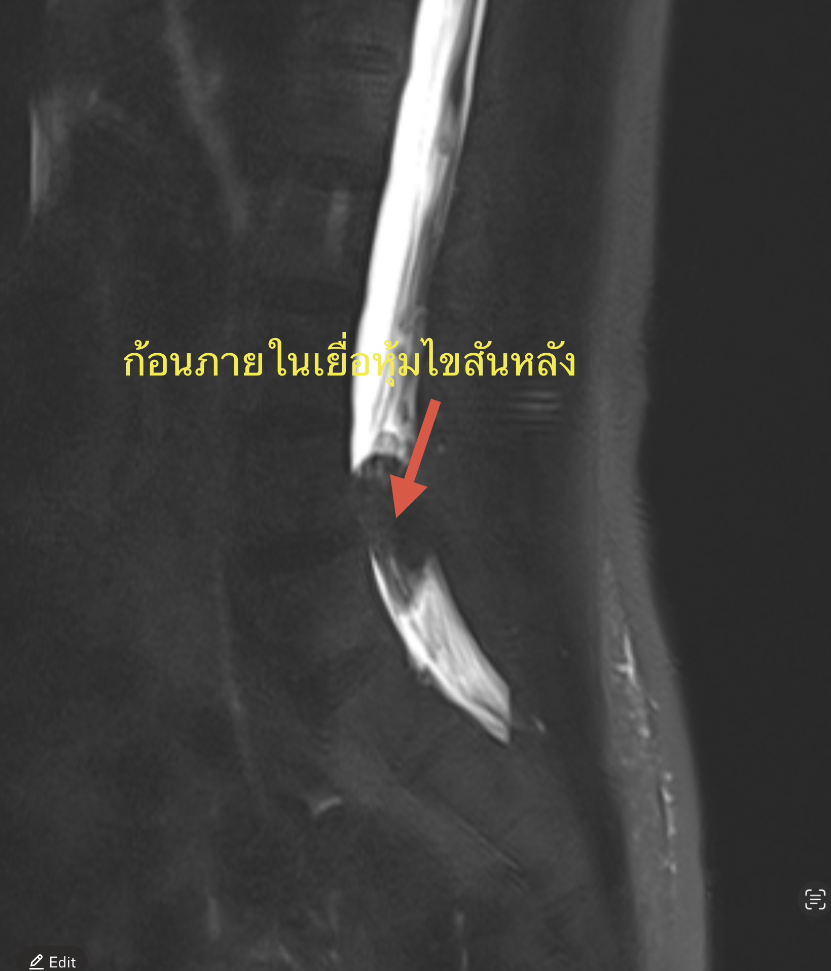 ปวดสะโพก–ชาลงขาเรื้อรัง รักษาแบบเดิมไม่ดีขึ้น ควรตรวจ MRI เพราะอาจมี “ก้อนกดเส้นประสาท” ซ่อนอยู่