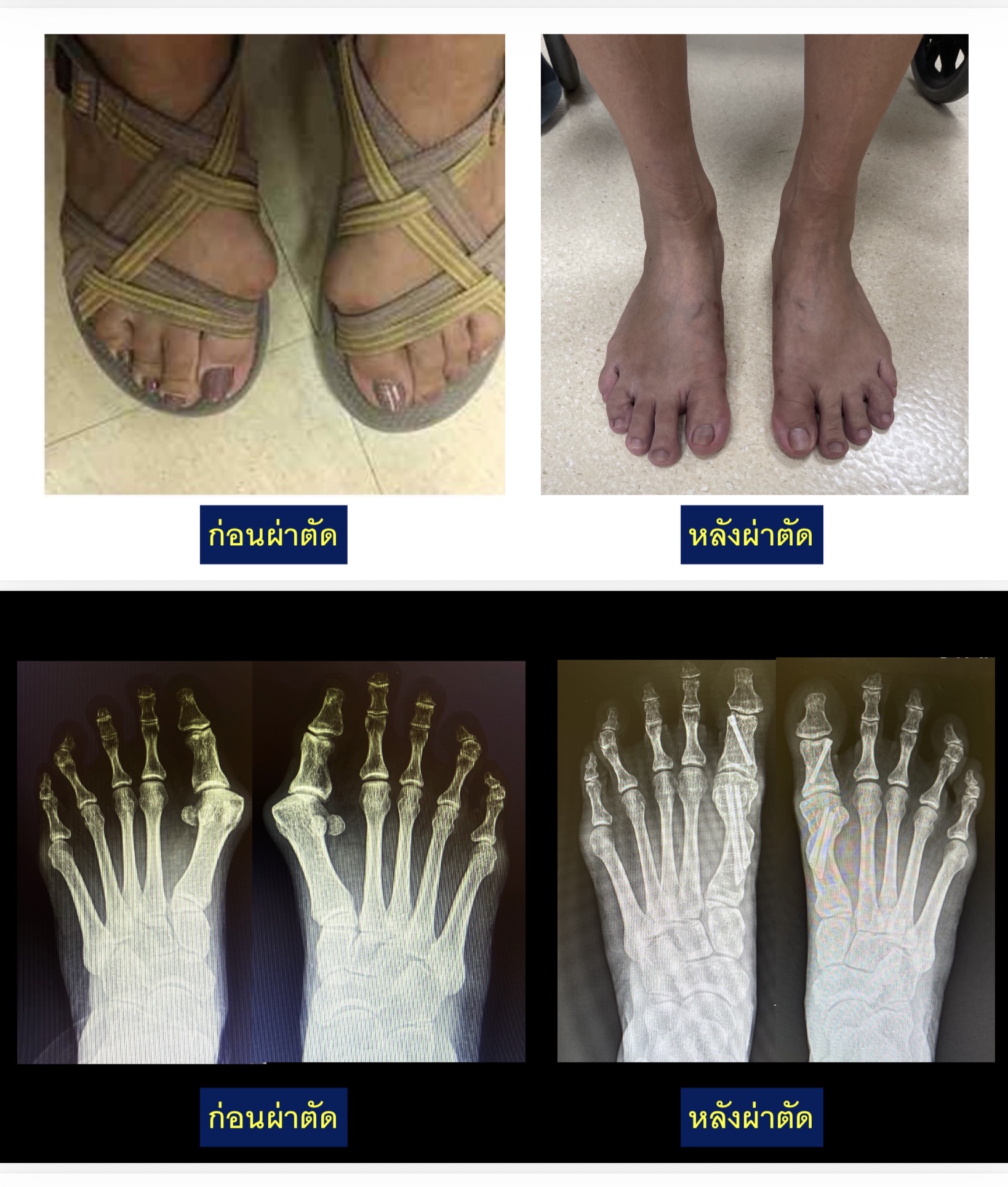 การรักษานิ้วหัวแม่เท้าเก (Hallux Valgus) ด้วยการผ่าตัดแผลเล็ก Minimally Invasive Surgery (MIS) — เจ็บน้อย ฟื้นตัวไว เดินได้เร็ว