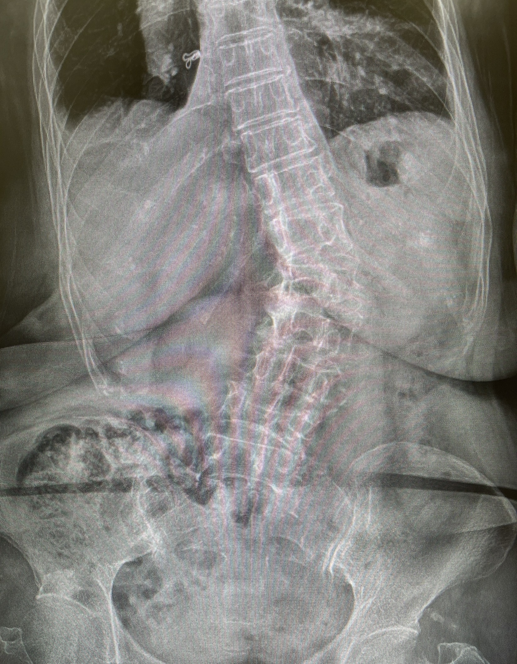 กระดูกสันหลังคดตั้งแต่กำเนิด (Congenital Scoliosis) — เข้าใจโรคนี้ให้ถูกต้อง พบเร็ว รักษาเร็ว เด็กมีโอกาสใช้ชีวิตปกติได้