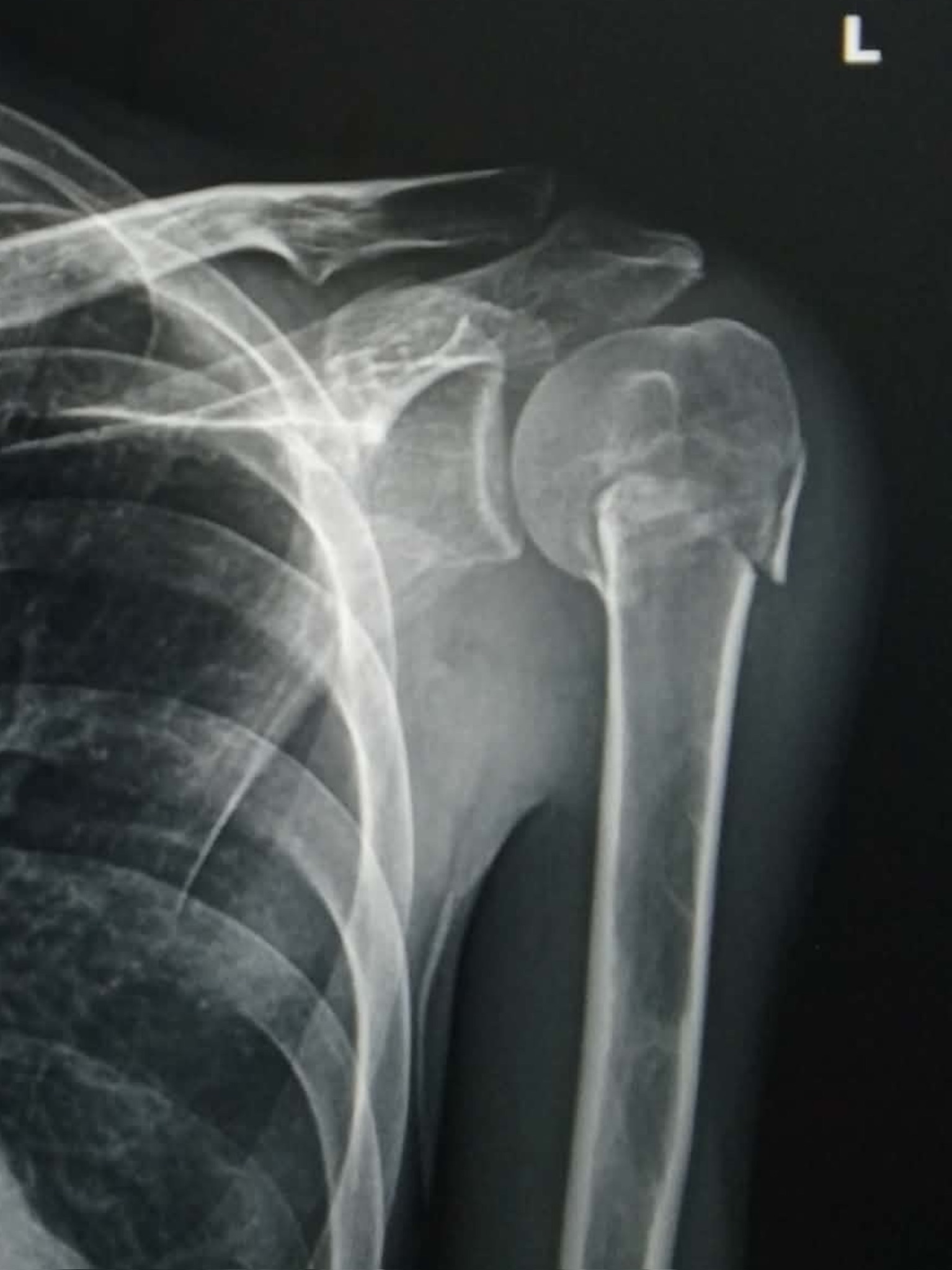 กระดูกต้นแขนส่วนบนหัก (Proximal Humeral Fracture) ต้องผ่าตัดไหม?
