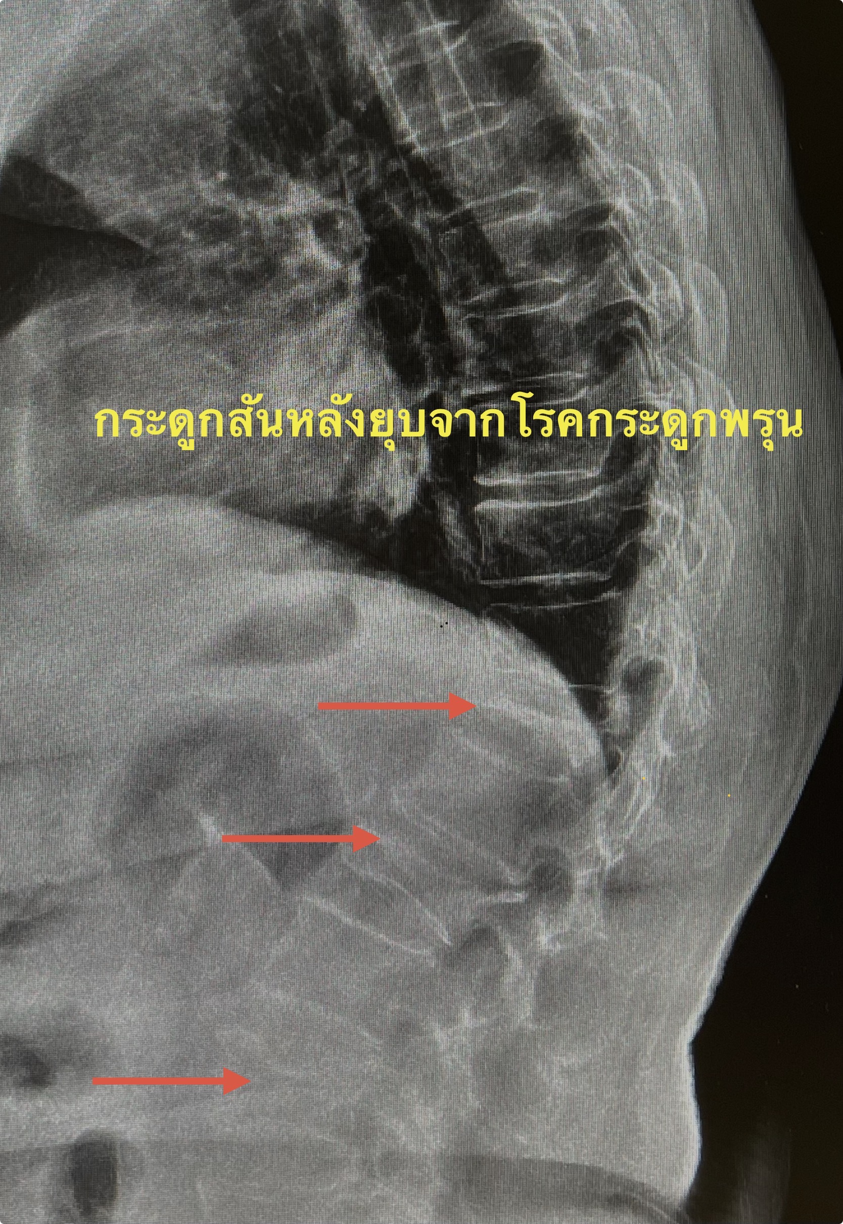 ปวดหลังมาก กระดูกสันหลังยุบหลายตำแหน่งจากโรคกระดูกพรุน — รักษาอย่างไร และป้องกันไม่ให้ยุบซ้ำ