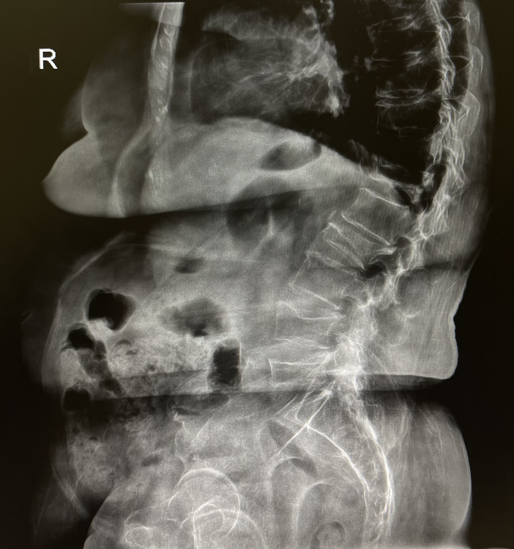 กระดูกสันหลังยุบ แยกอย่างไรว่าเป็น “กระดูกพรุน” หรือ “มะเร็งลุกลาม–Multiple Myeloma”?