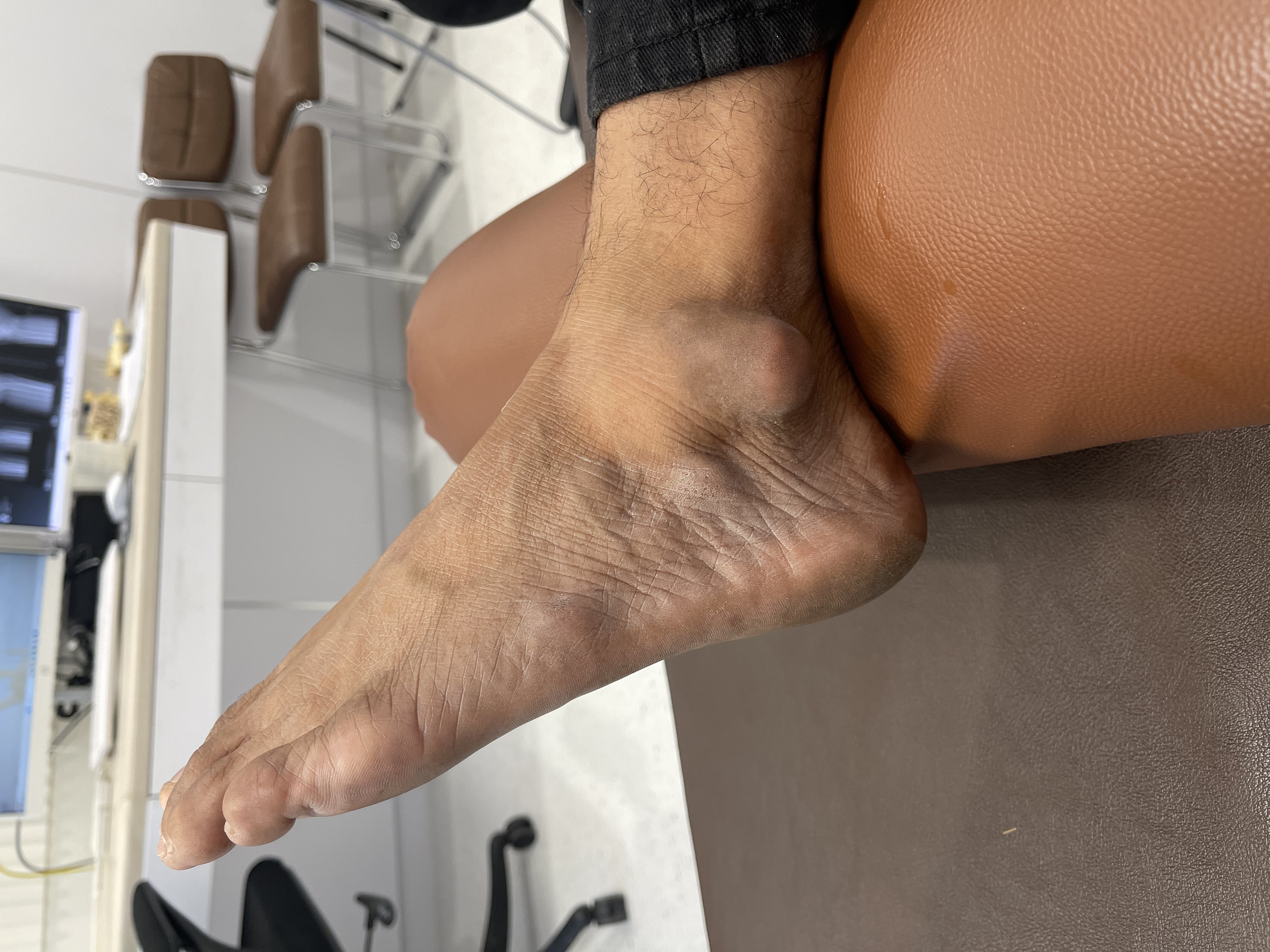 ก้อนโทฟาย (Tophi Gout) รักษาอย่างไร?