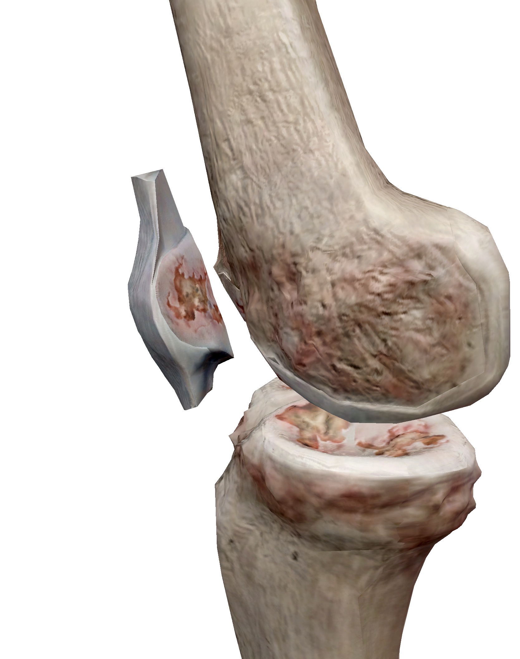 ปวดหน้าเข่า จากกระดูกอ่อนผิวข้อสะบ้าอักเสบ–สึก (Patellofemoral Arthritis) รักษาอย่างไร?