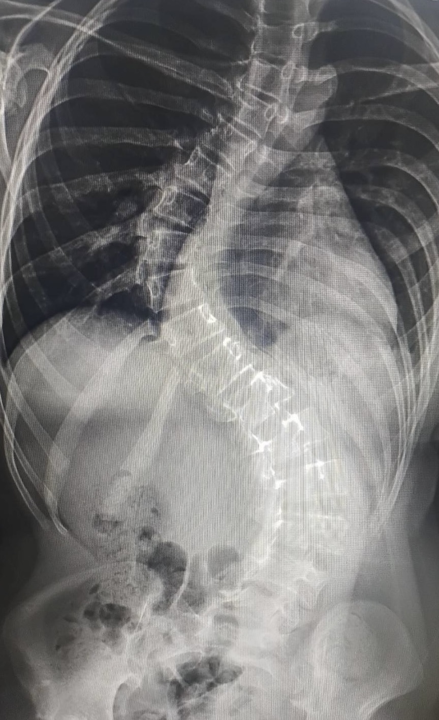 กระดูกสันหลังคดในเด็ก (Congenital Scoliosis) รักษาอย่างไร? เมื่อไหร่ต้องผ่าตัด และผ่าตัดทำอะไร