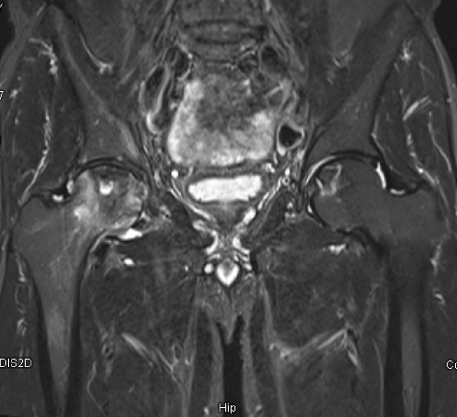 กระดูกหัวสะโพกตาย (Avascular Necrosis — AVN) แนวทางการวินิจฉัยและการรักษา