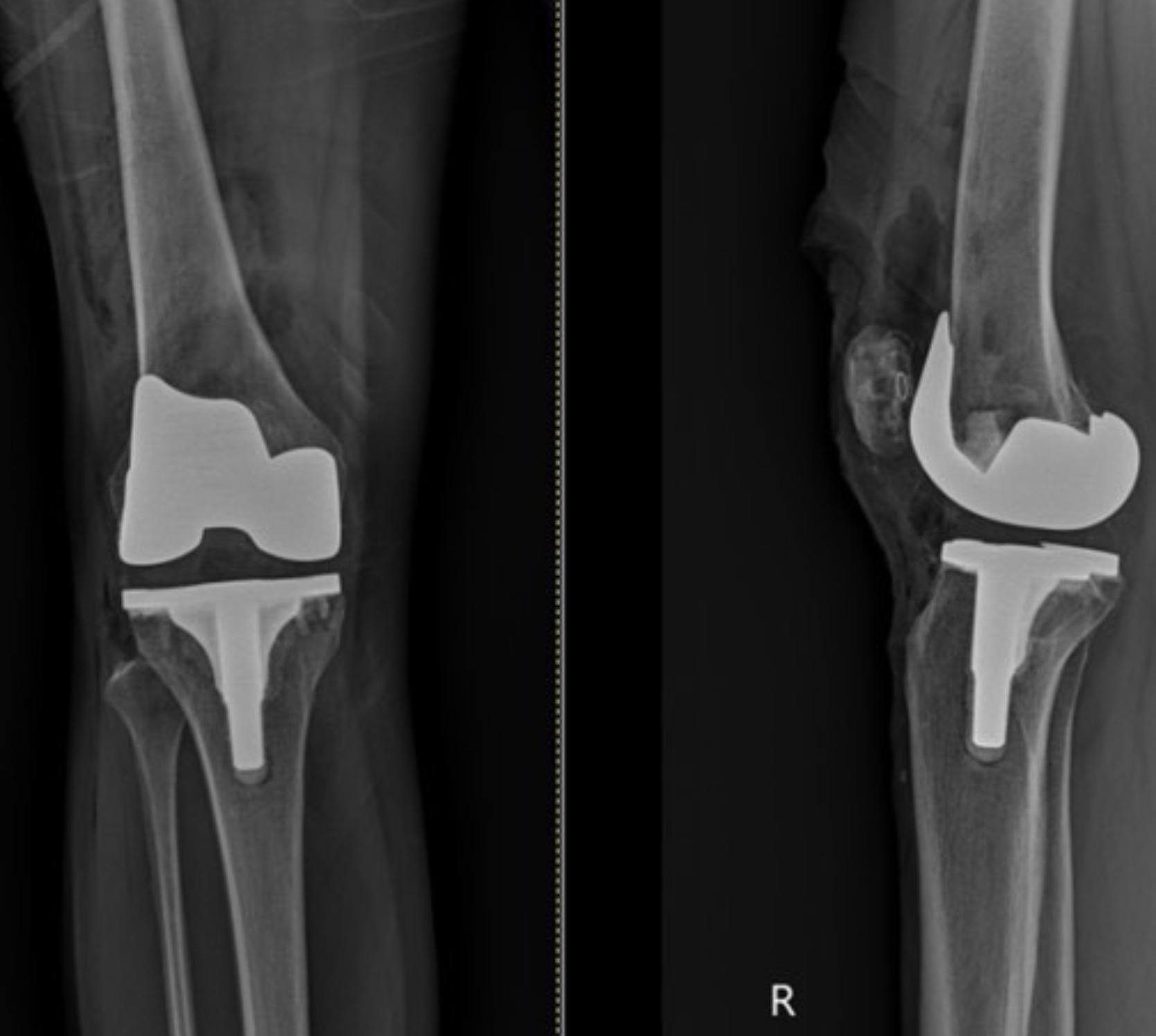 ผ่าตัดเปลี่ยนข้อเข่าเทียม (Total Knee Replacement) คืออะไร? การเตรียมตัว–การผ่าตัด–การปฏิบัติตัวหลังผ่า