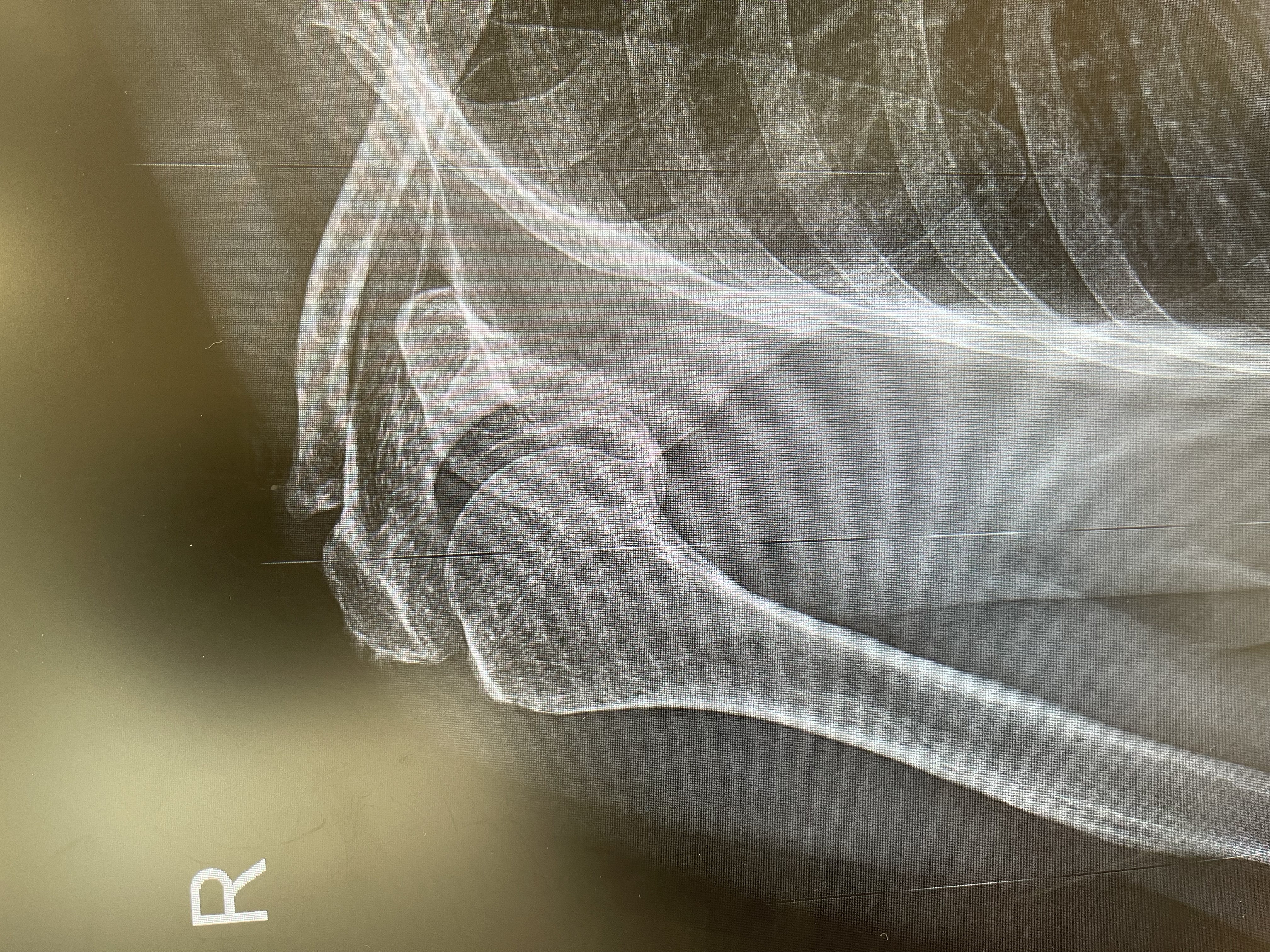 ไหล่ติด (Frozen Shoulder / Adhesive Capsulitis) ปวดตึง ยกแขนไม่ขึ้น คืออะไร? รักษาอย่างไร