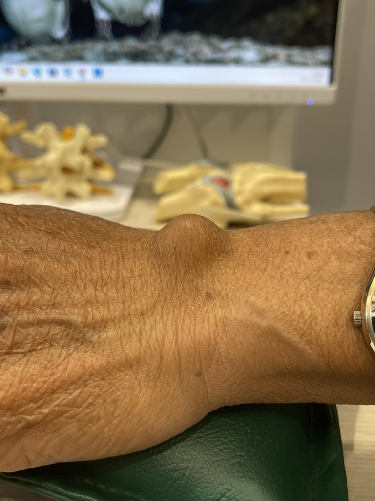 ก้อนที่หลังมือ Dorsal Carpal Ganglion Cyst คืออะไร? อันตรายไหม และควรรักษาอย่างไร