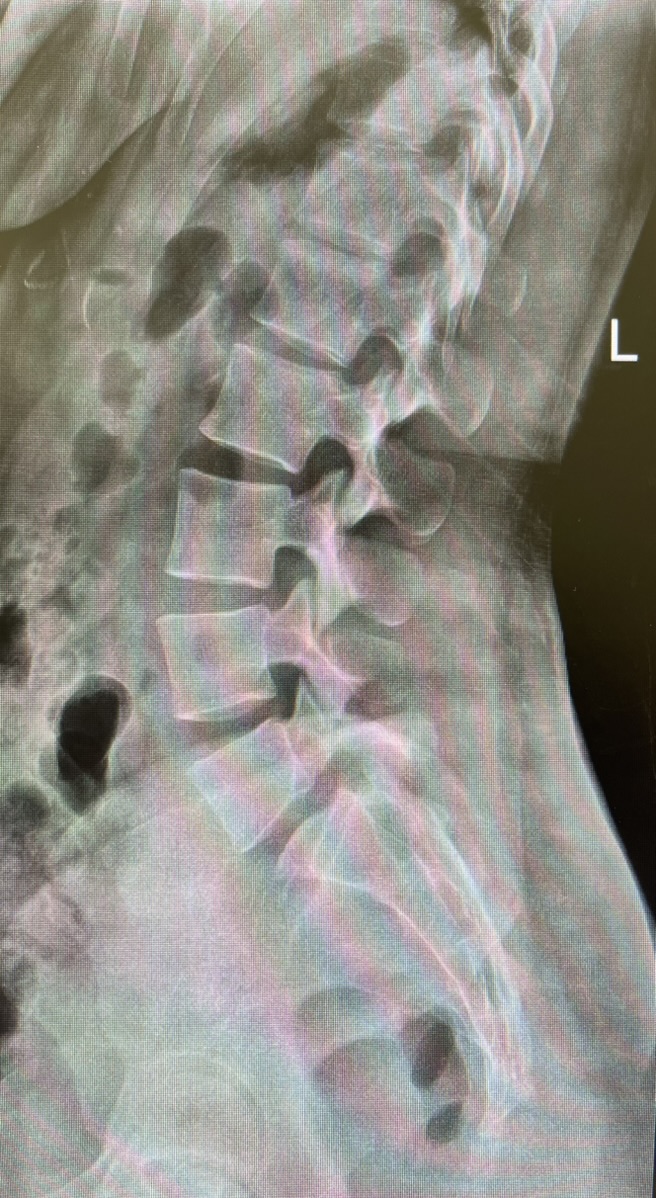 ปวดหลังเรื้อรังในวัย 30 ปี ตรวจพบ Spondylolysis L5–S1 with Spondylolisthesis สาเหตุ อาการ และการรักษา