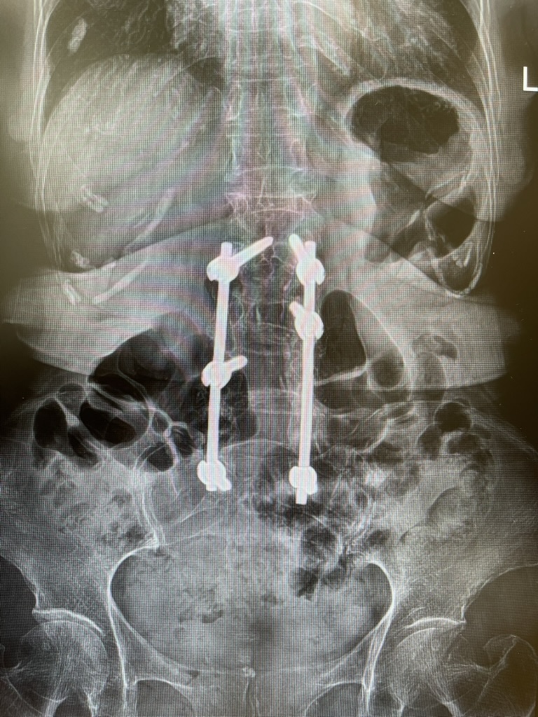 ทำไมผู้ที่เคยใส่สกรูยึดกระดูกสันหลัง (pedicular screw) ถึงเสี่ยง “กระดูกสันหลังยุบ” มากกว่าคนทั่วไป?