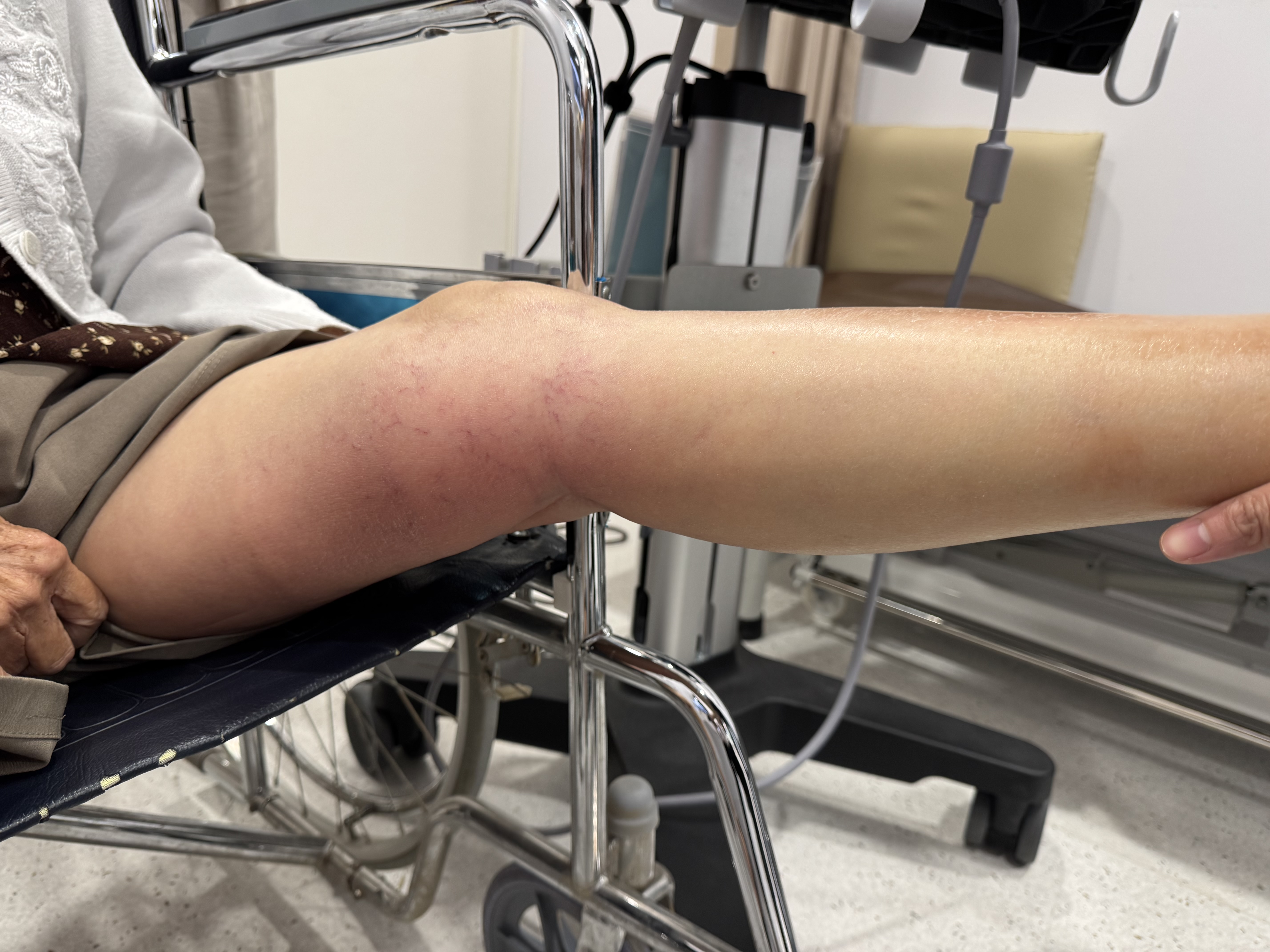 ผู้ป่วยลิ่มเลือดอุดตันในหลอดเลือดดำ (DVT) ทำไม “ต้องหาสาเหตุ” ทุกครั้ง? เพราะเบื้องหลังอาจมีโรคสำคัญซ่อนอยู่