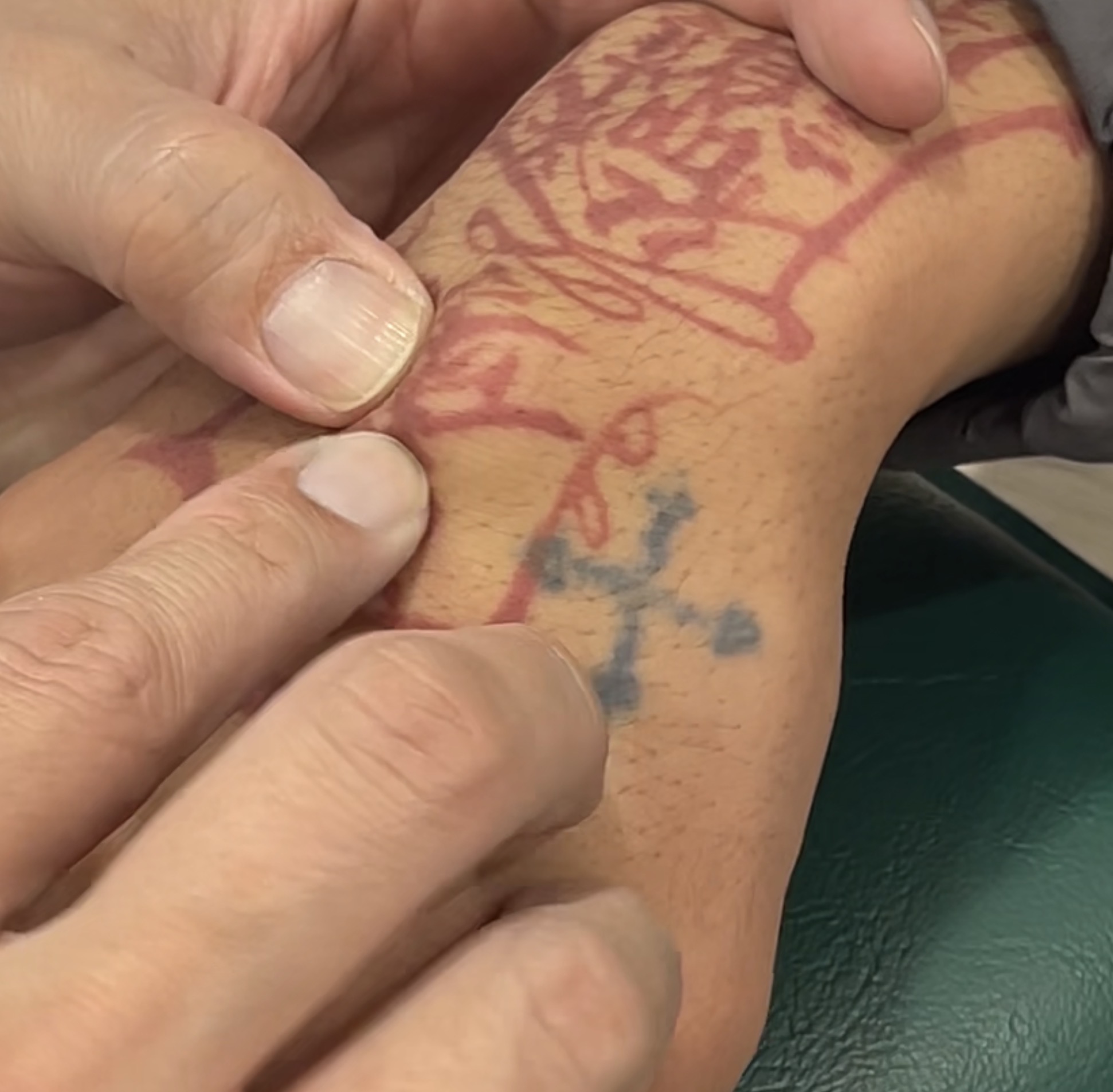 มีก้อนปูดที่ข้อมือ! ใช่เนื้องอกไหม? หรือแค่ "ถุงน้ำ" ที่ไม่ต้องผ่าตัด? (Ganglion Cyst)