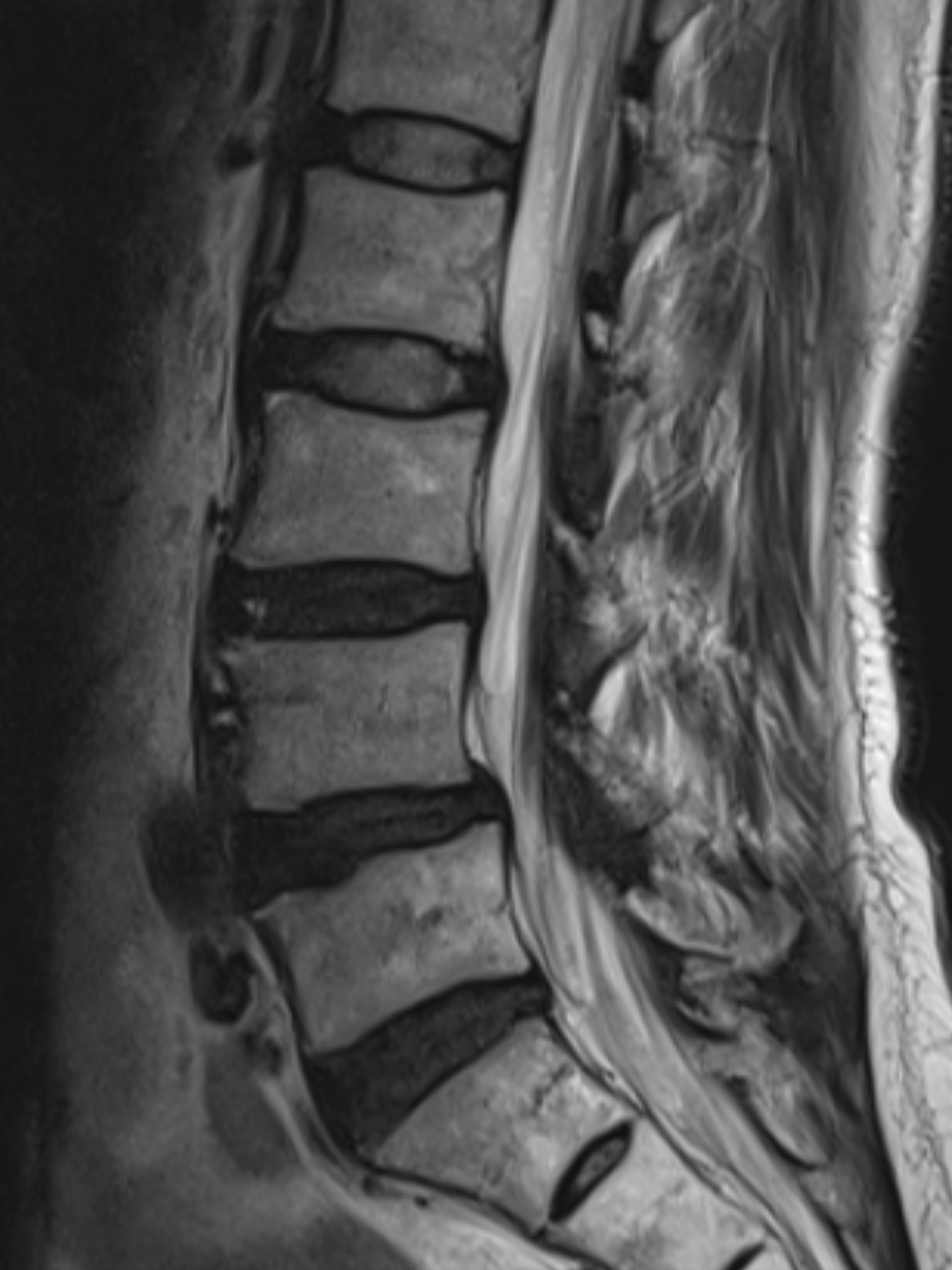 อายุ 57 ปวดหลังร้าวลงขา... ผล MRI บอก "กระดูกเสื่อมหลายระดับ" ต้องกังวลแค่ไหน?