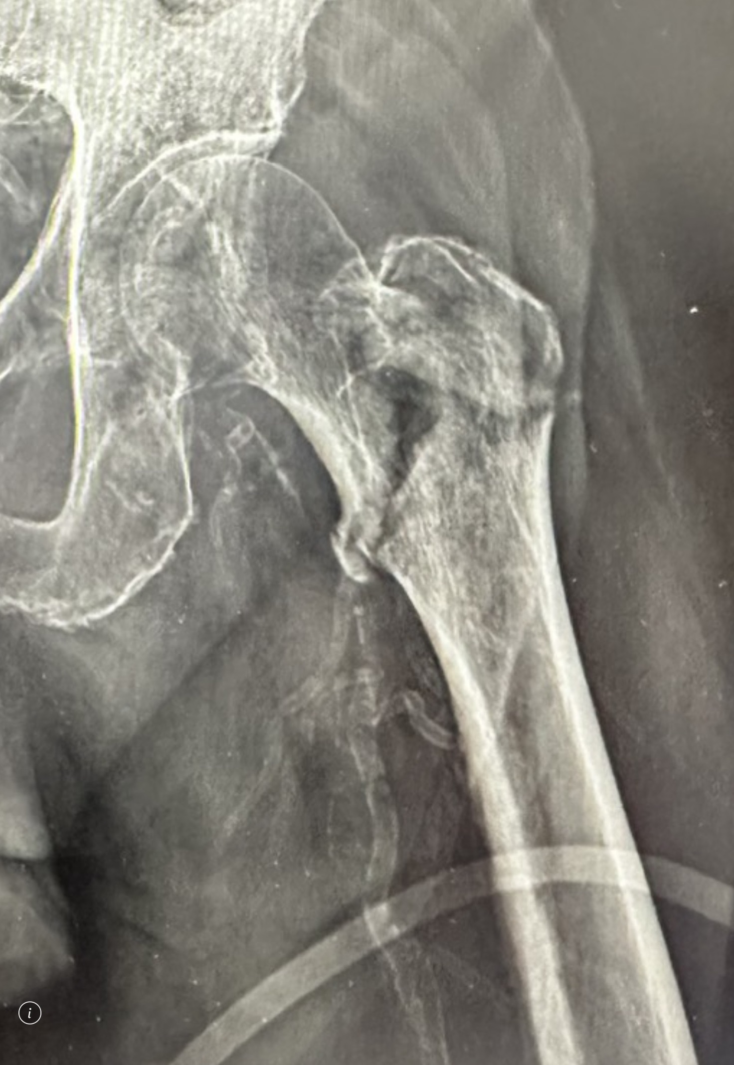 ผู้สูงอายุล้ม "สะโพกหัก" (Intertrochanteric Fracture)... ผ่าตัด VS ไม่ผ่าตัด ทางไหนคือทางรอด?