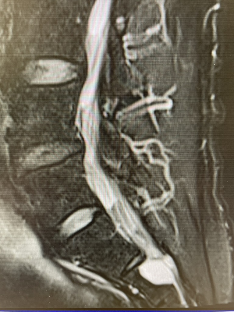 Tarlov Cyst เจอจาก MRI...ใช่สาเหตุของปวดหลังจริงไหม หรือแค่บังเอิญ?