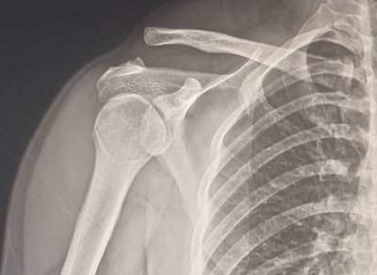 เจ็บไหล่ด้านบน… ใช่ AC Joint Injury หรือเปล่า? แล้วถ้าข้อแยกเยอะ ต้องรักษาอย่างไร?