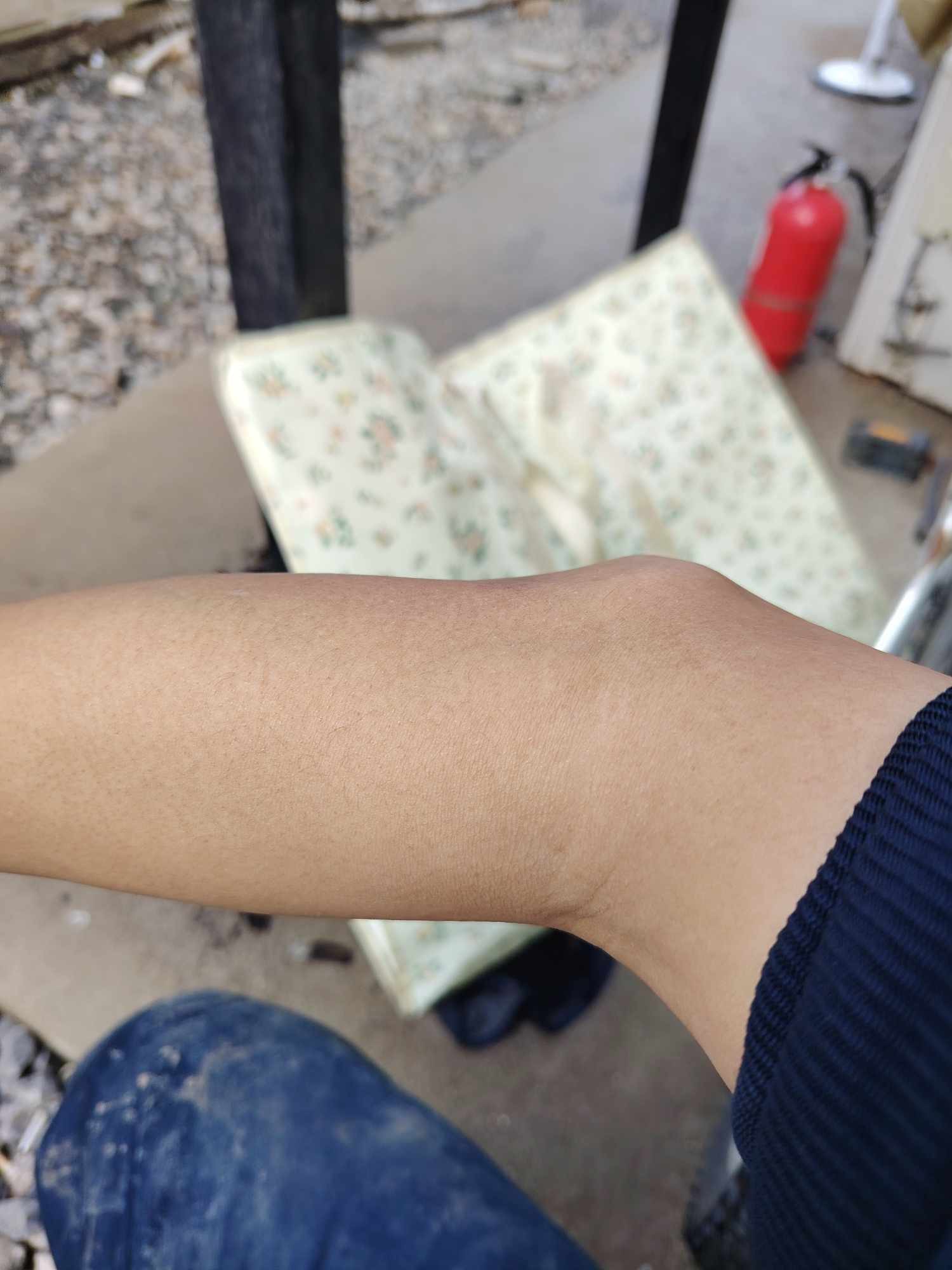 แขนเบี้ยว ศอกงอผิดรูป...แผลใจจากวัยเด็กที่แก้ไขได้! เรื่องของ "ศอกคอก" (Cubitus Varus) ที่ไม่ได้มีแค่ความไม่สวย