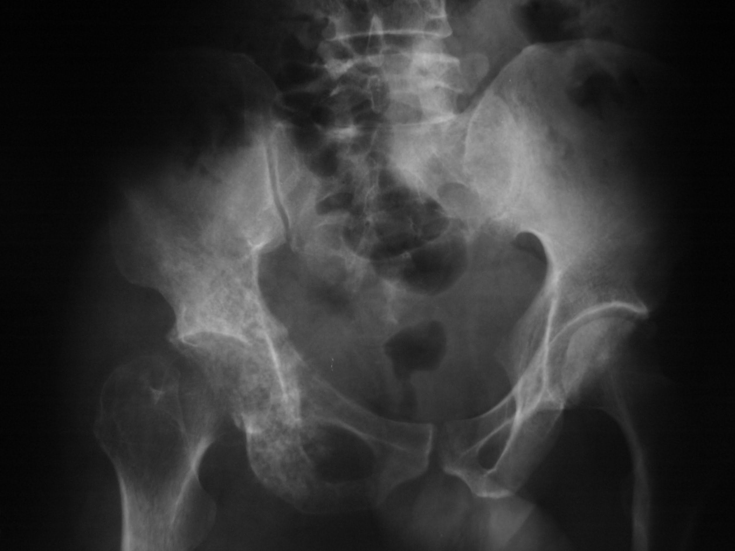 เมื่อมะเร็งกินกระดูกจน "หัก" (Pathologic Fracture)... ต้องนอนเข้าเฝือก หรือผ่าตัดใส่เหล็กได้? ทางเลือกเพื่อศักดิ์ศรีและคุณภาพชีวิต