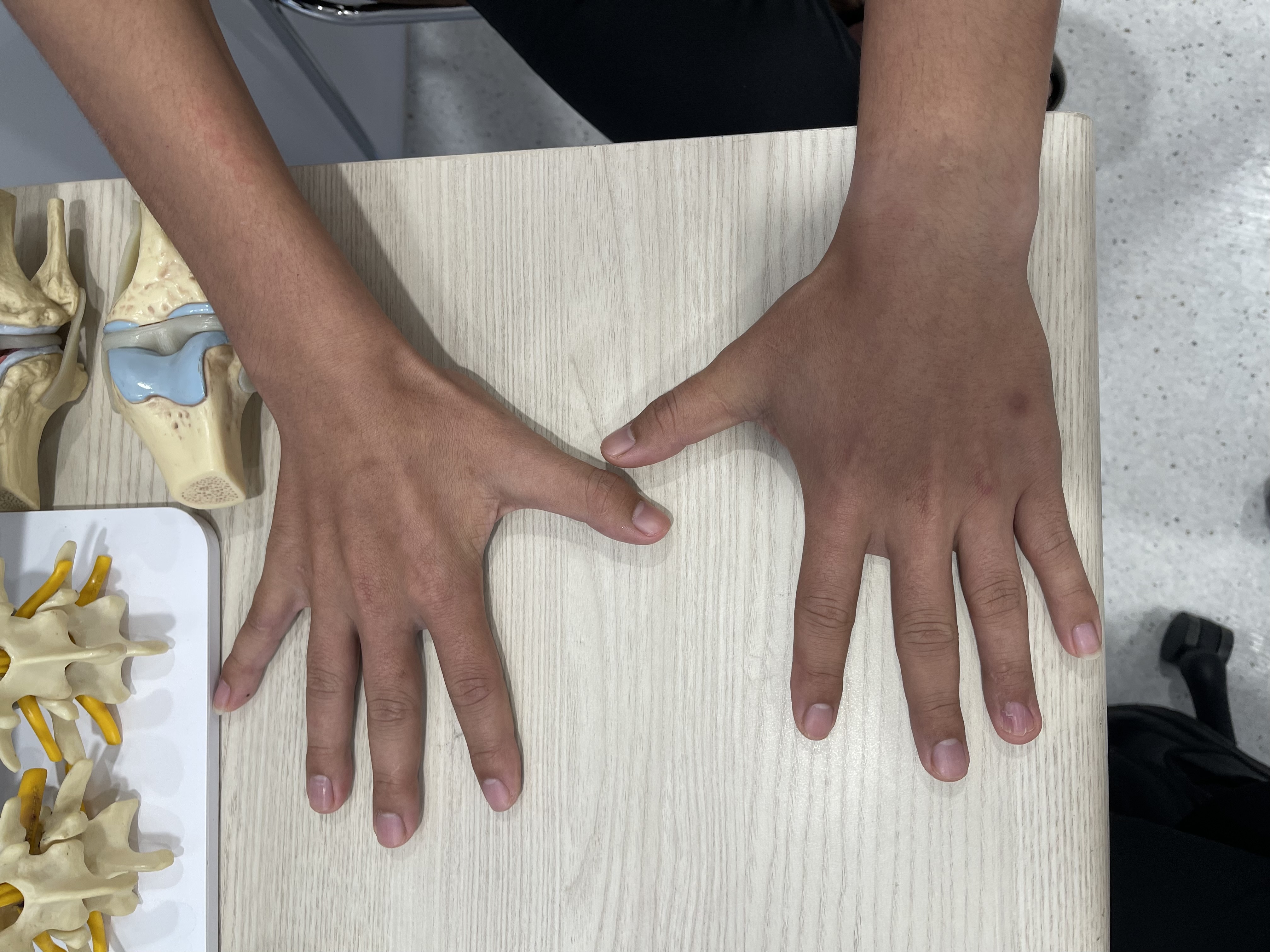 มือลีบ นิ้วงอ แต่อ่อนแรงข้างเดียว? ระวัง! โรค Hirayama ภัยเงียบวัยรุ่นชาย