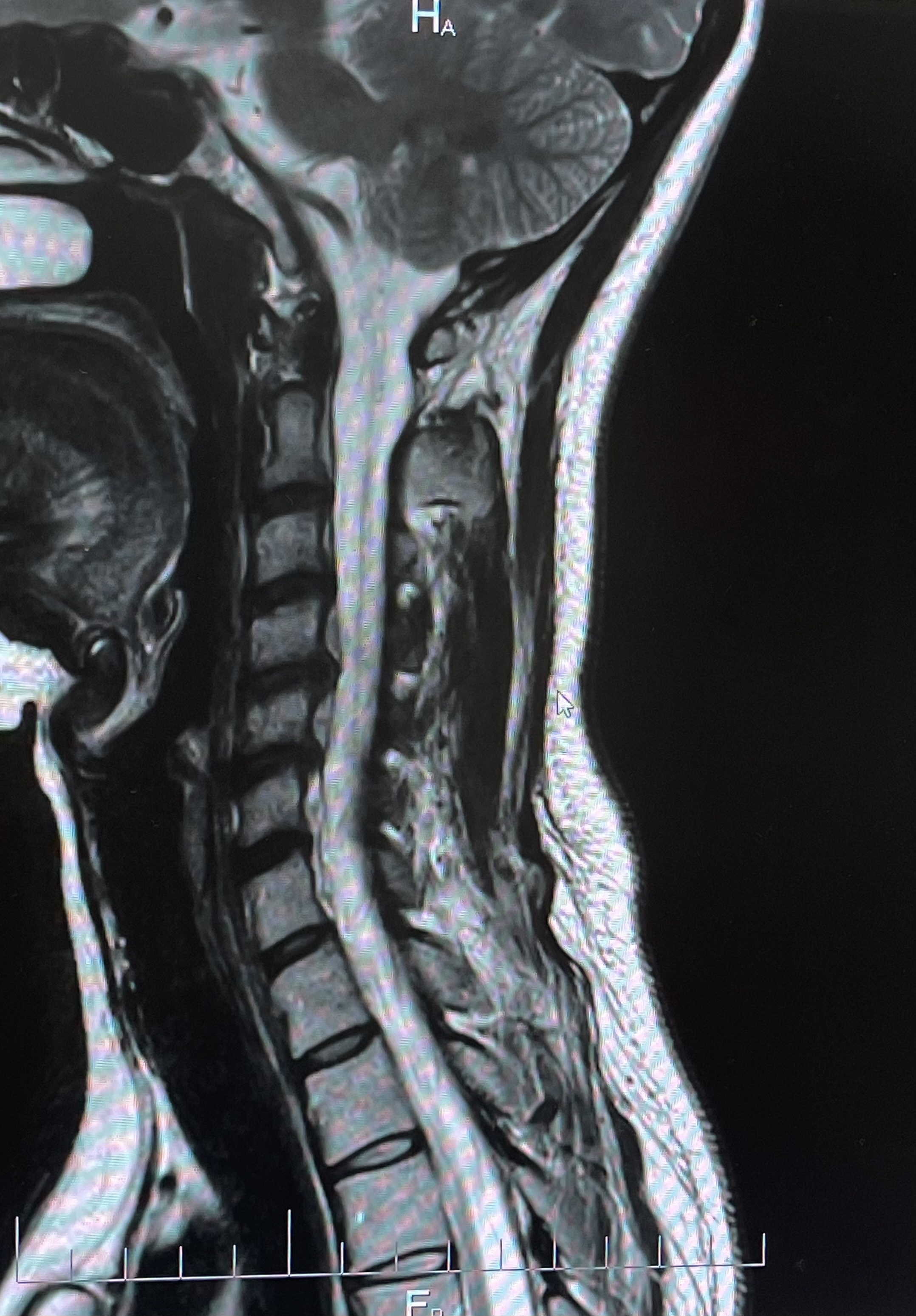 หันซ้ายก็โอย... หันขวาก็เจ็บ" ปวดลึกๆ ที่คอ MRI เจอ C5-6 มีปัญหา ต้องผ่าตัดไหม?