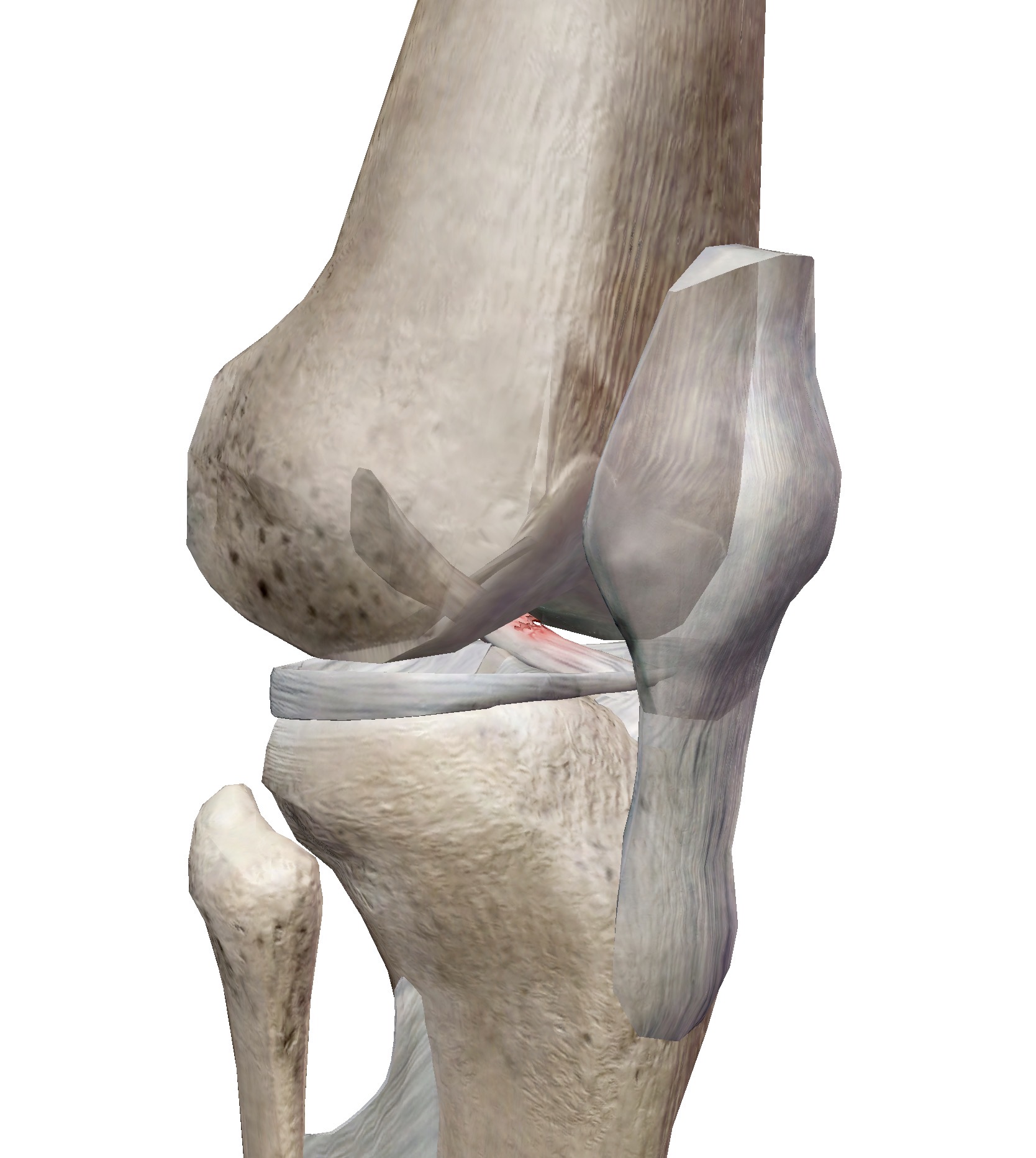 เอ็นไขว้หน้า (ACL) ขาด... จำเป็นต้องผ่าตัดทุกคนไหม? ถ้าปล่อยไว้เสี่ยง "เข่าเสื่อม" ก่อนวัยจริงหรือเปล่า?