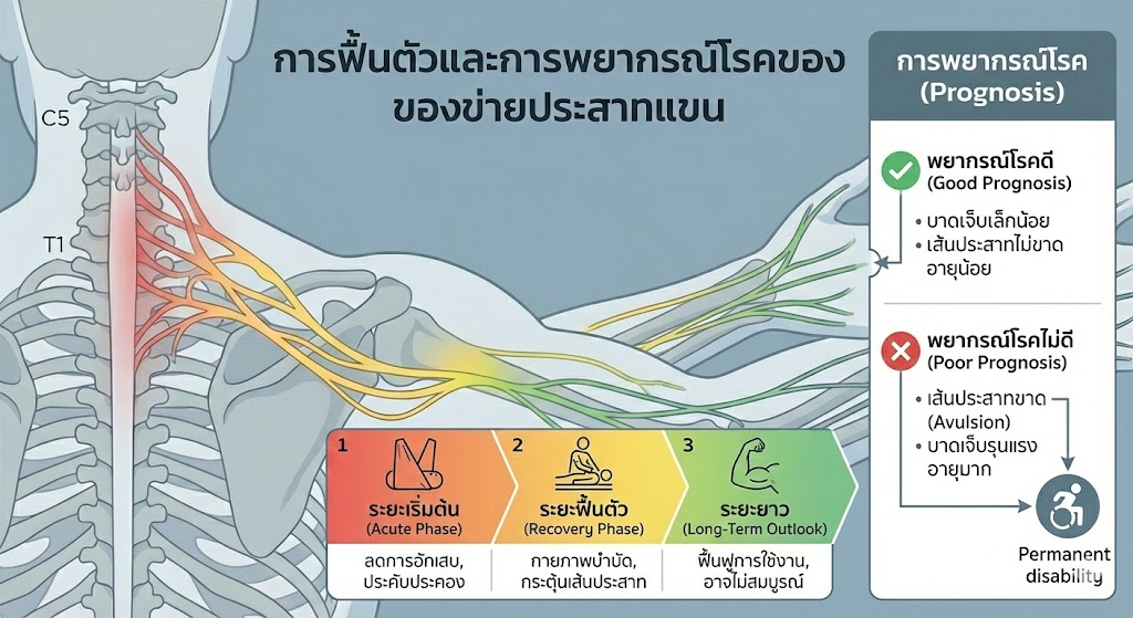 แขนจะกลับมาใช้ได้เหมือนเดิมไหม? : เจาะลึกเส้นทาง "การฟื้นตัว" ของเส้นประสาทข่ายแขน ที่คนไข้และญาติแอบกังวล