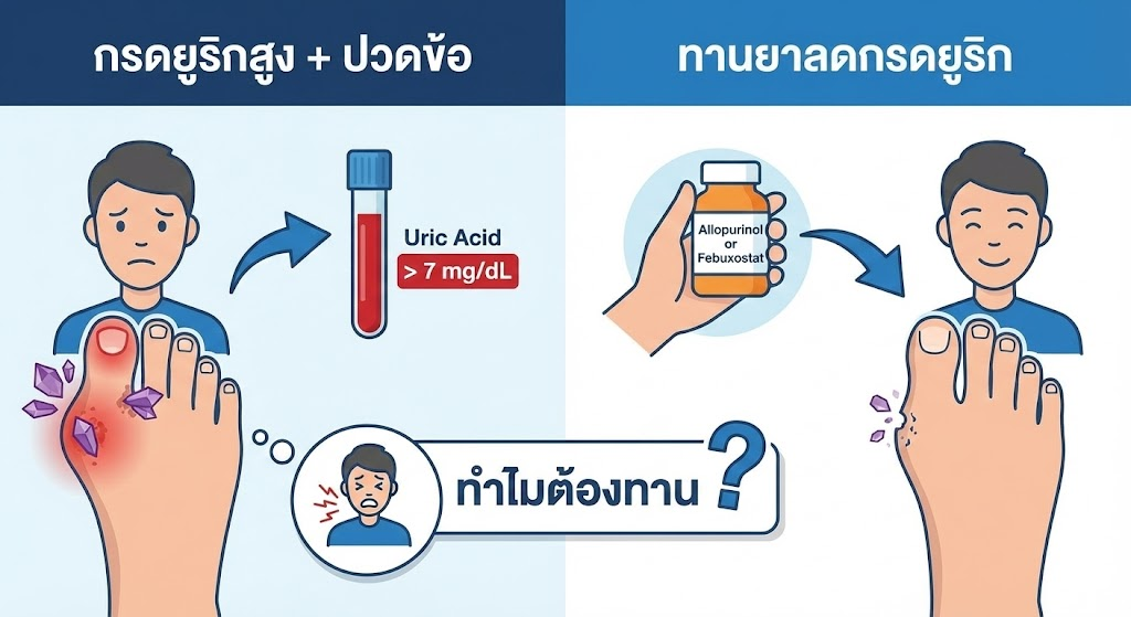 กลัวกินยาเก๊าท์แล้วไตพัง? หยุดคิดแบบนั้นก่อนสาย! ความจริงคือ "ยูริกสูง" ที่ไม่รักษาต่างหาก คือเพชฌฆาตเงียบทำลายไต มารู้วิธีรักษาที่ถูกต้องและปลอดภัยกันครับ