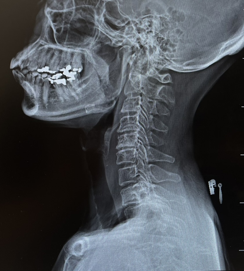อายุ 45 ปี ปวดคอร้าวลงแขน ชานิ้วชี้: สัญญาณเตือนจากกระดูกต้นคอที่ควรรู้